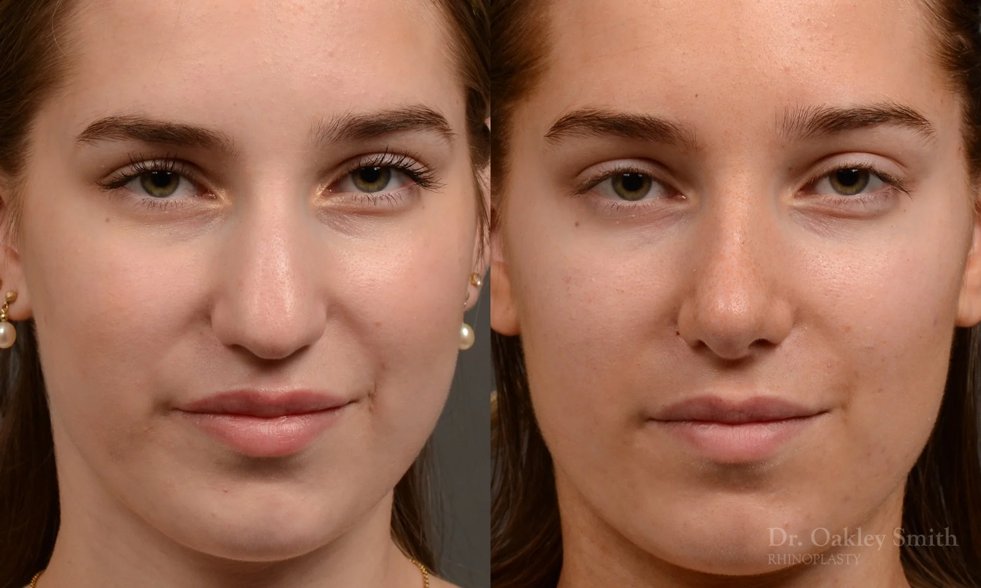 537A-rhinoplasty-before-after-top-toronto-nose-surgeon.jpg