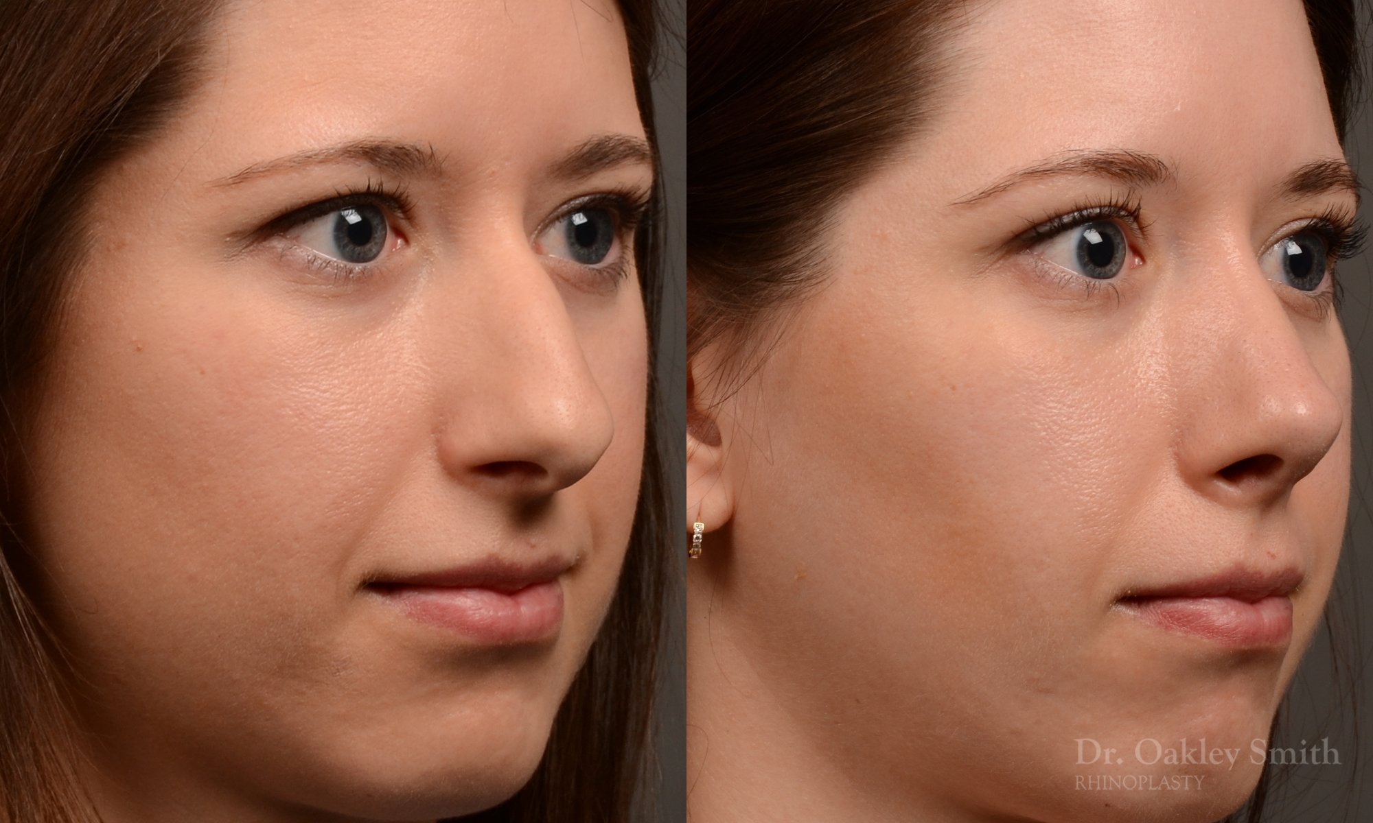 516B-rhinoplasty-dr-oakley-smith-toronto-top-surgeon-nose-job.jpg