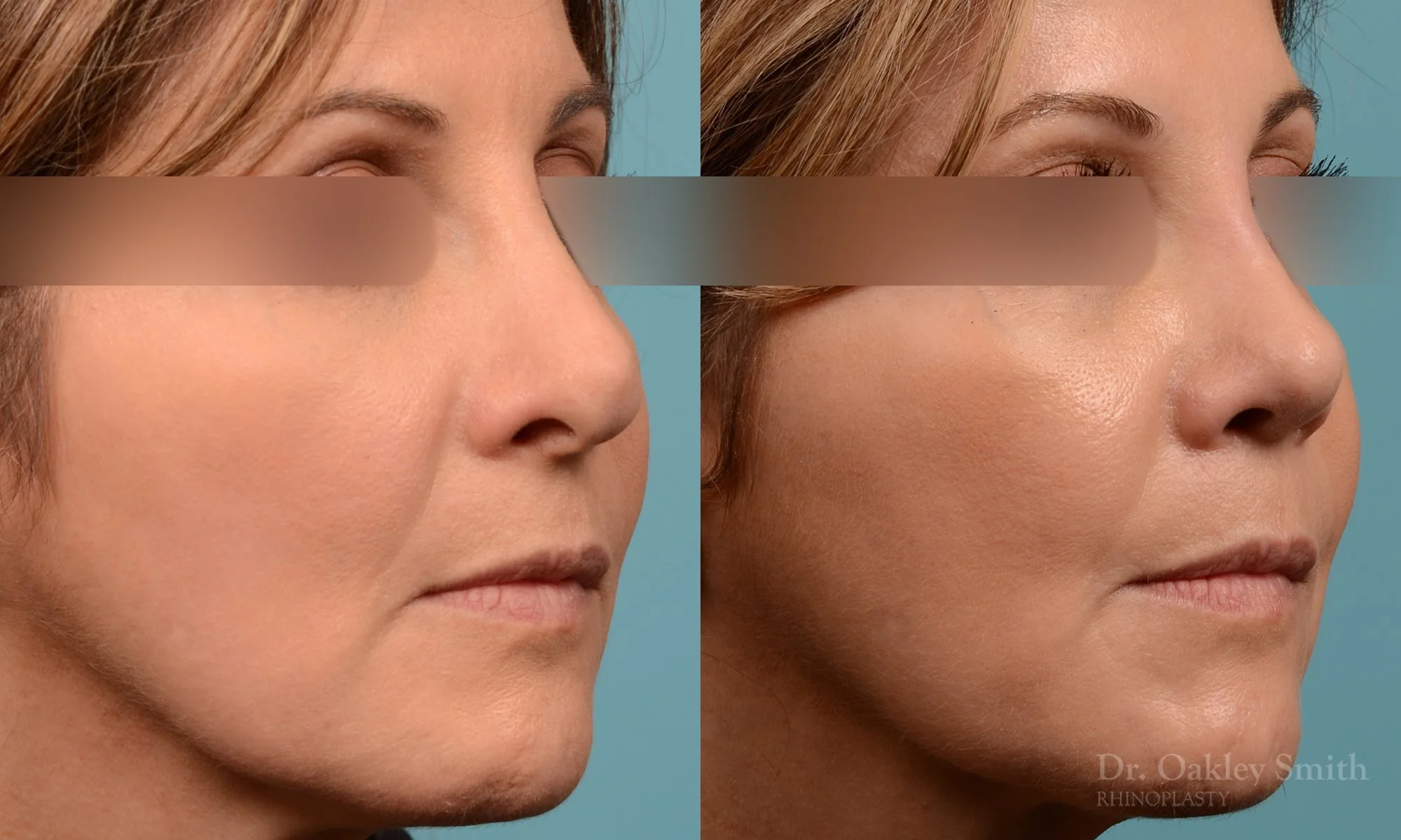 244B-rhinoplasty-dr-oakely-smith-septum (1).jpg