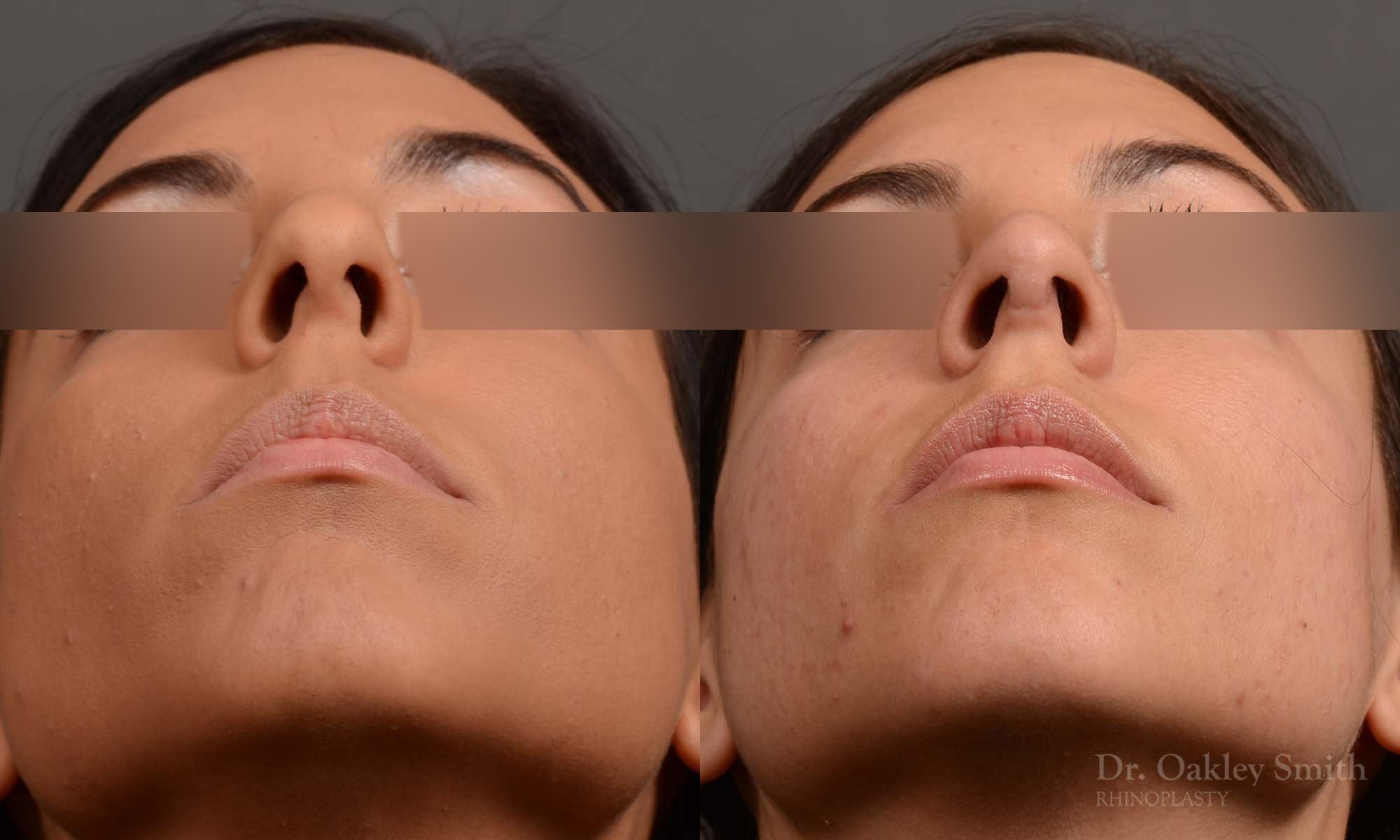 320F-rhinoplasty-dr-oakley-smith-toronto-nose-job.jpg