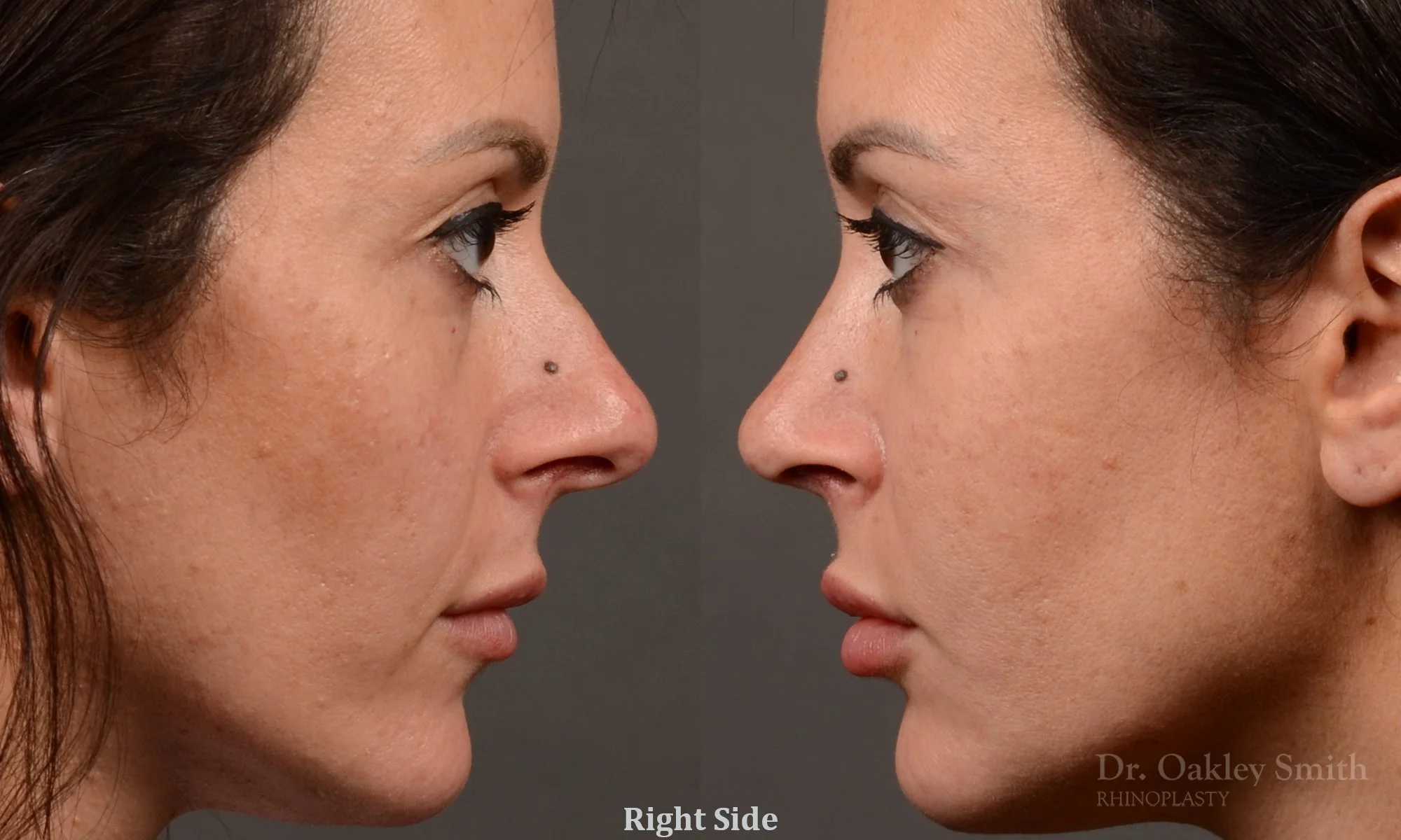 495C-rhinoplasty-dr-oakley-smith-toronto-top-surgeon-nose-job.jpg