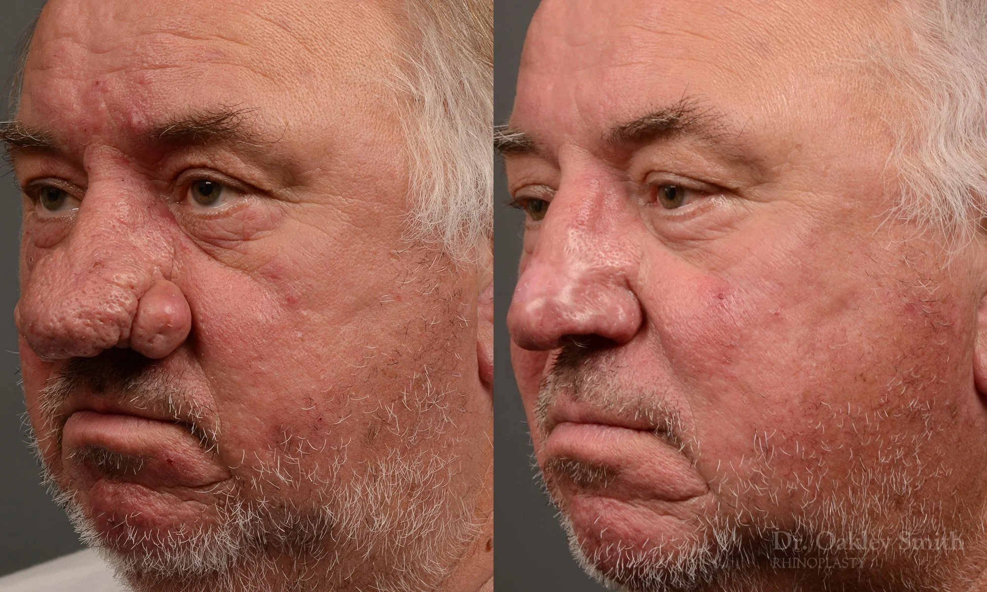 471D-rhinoplasty-septoplastry-dr-oakley-smith-toronto-top-surgeon-nose-job.jpg