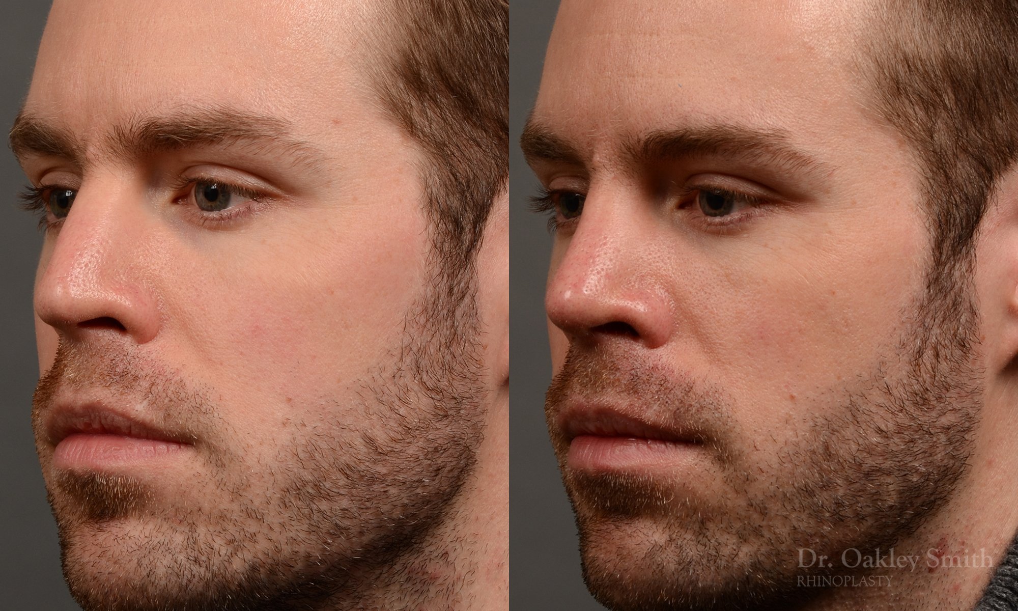 337D-rhinoplasty-dr-oakley-smith-toronto-nose-job.jpg