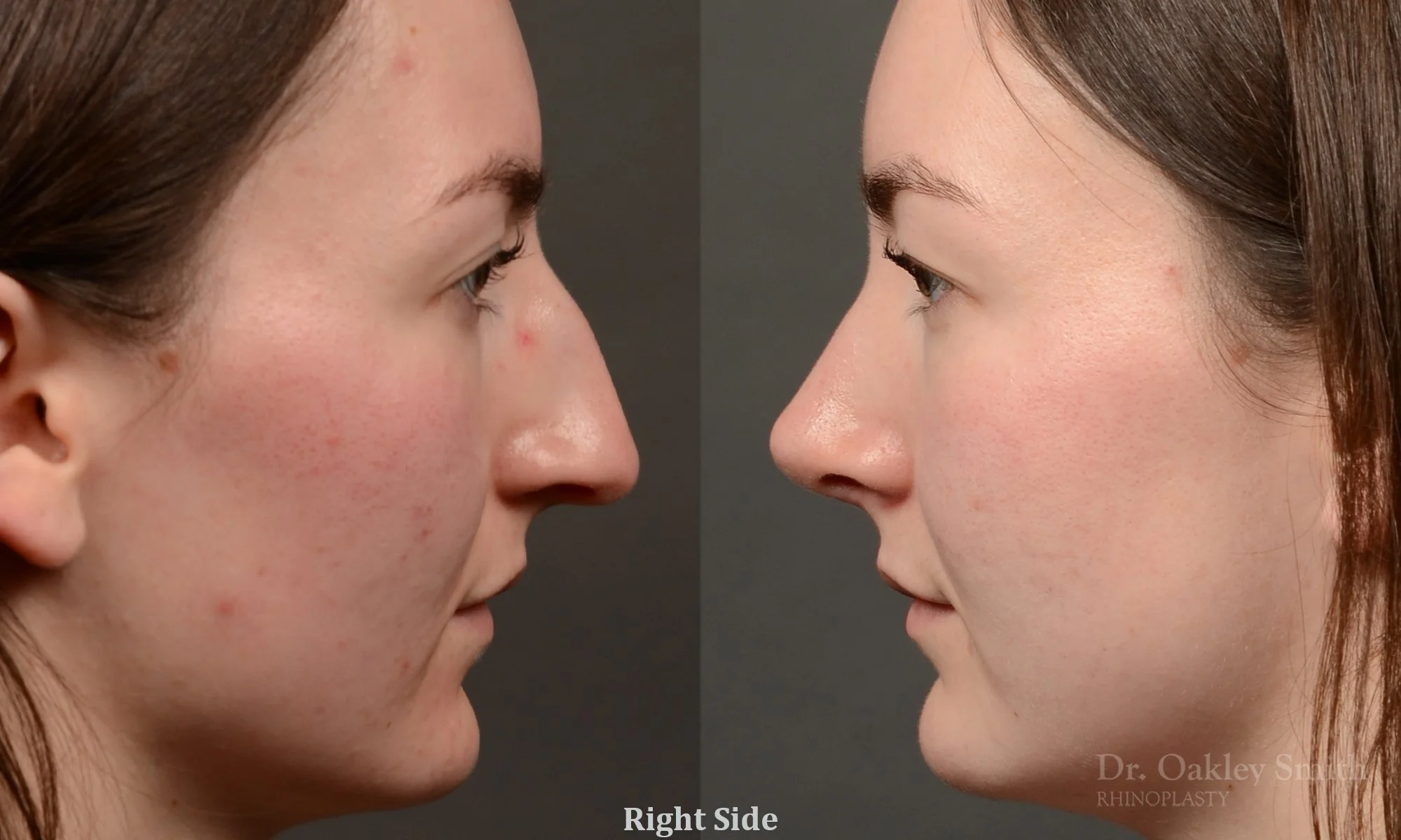 556: Female Rhinoplasty, Dorsal Hump, Tip Narrowing and Rotation