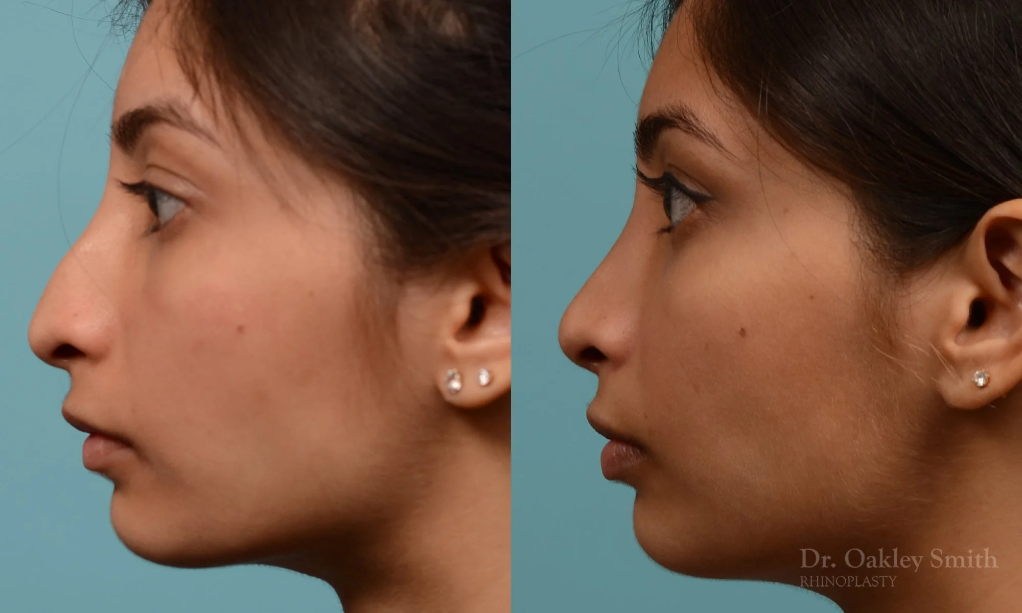 272.5E-rhinoplasty-dr-oakley-smith-toronto-nose-job.jpg