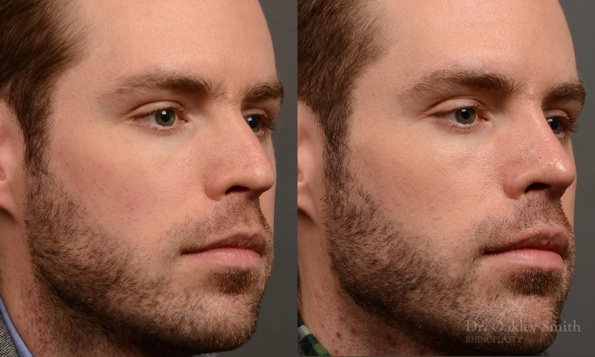 337B-rhinoplasty-dr-oakley-smith-toronto-nose-job.jpg