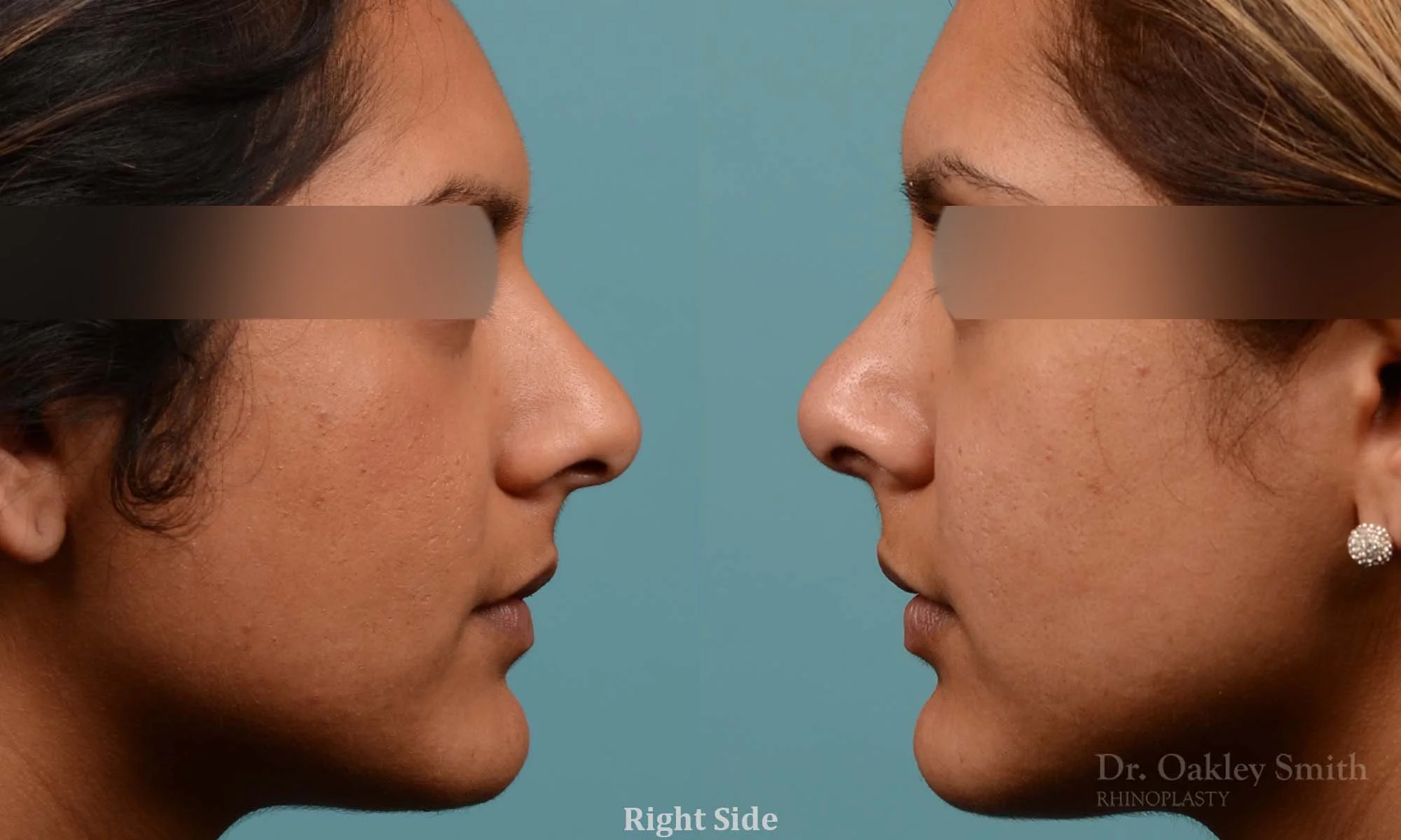 271: Female, Ethnic Rhinoplasty, Thick Skin, Dorsal Hump, Tip Refinement