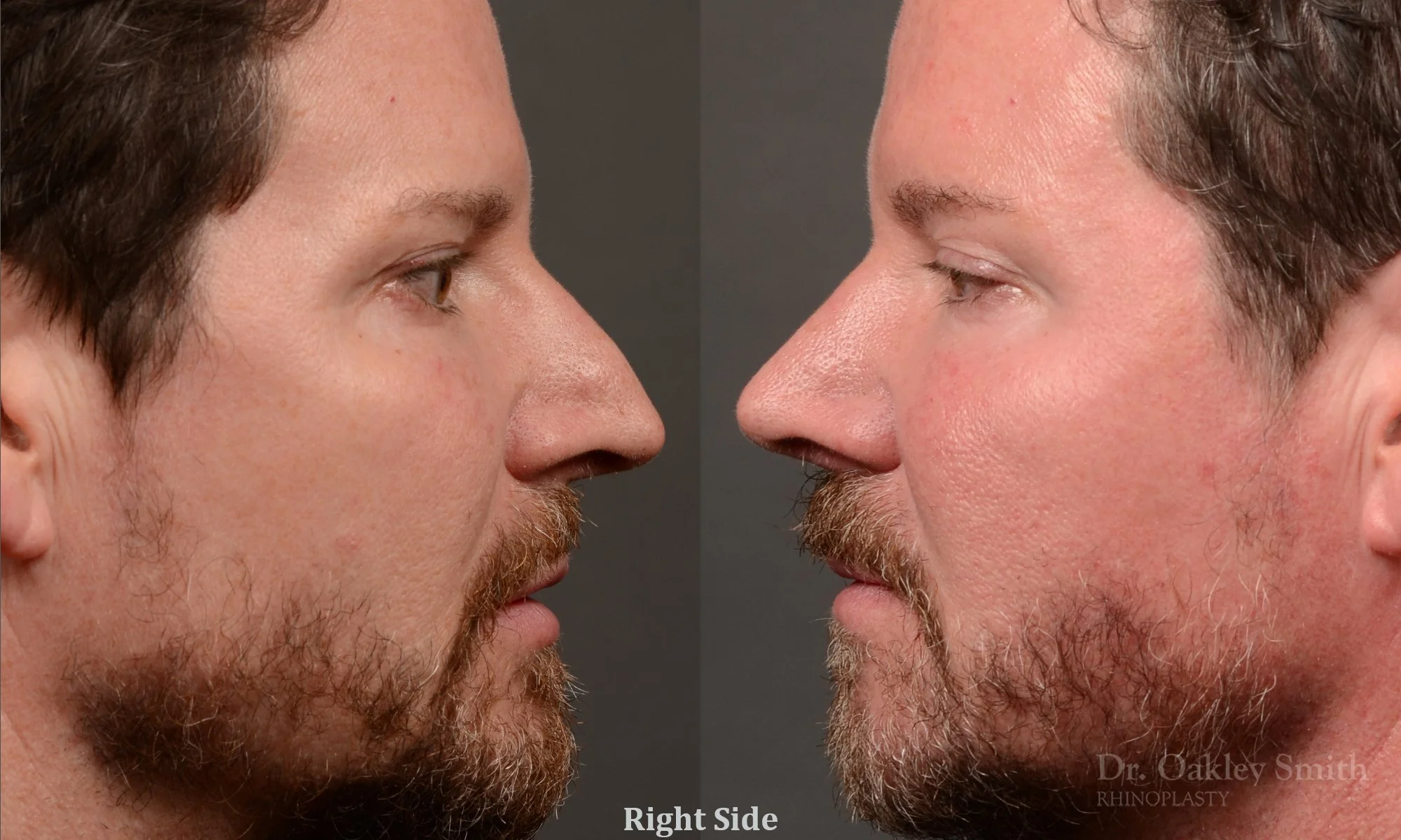 560: Primary Male Rhinoplasty, Hump, Normal Skin