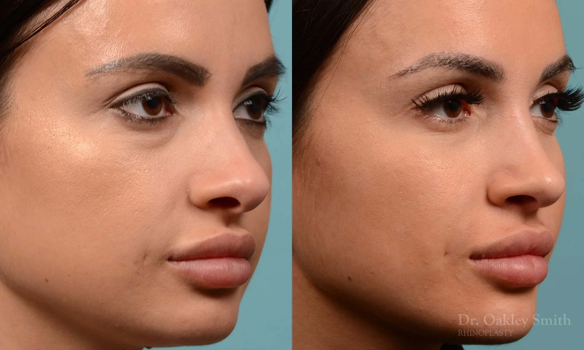 259B-rhinoplasty-dr-oakley-smith-toronto-nose-job.jpg