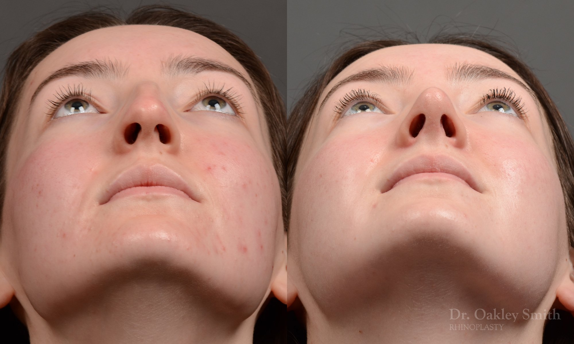 Case 556 dr oakley smith, female rhinoplasty, 12 months after surgery, submental view.jpg