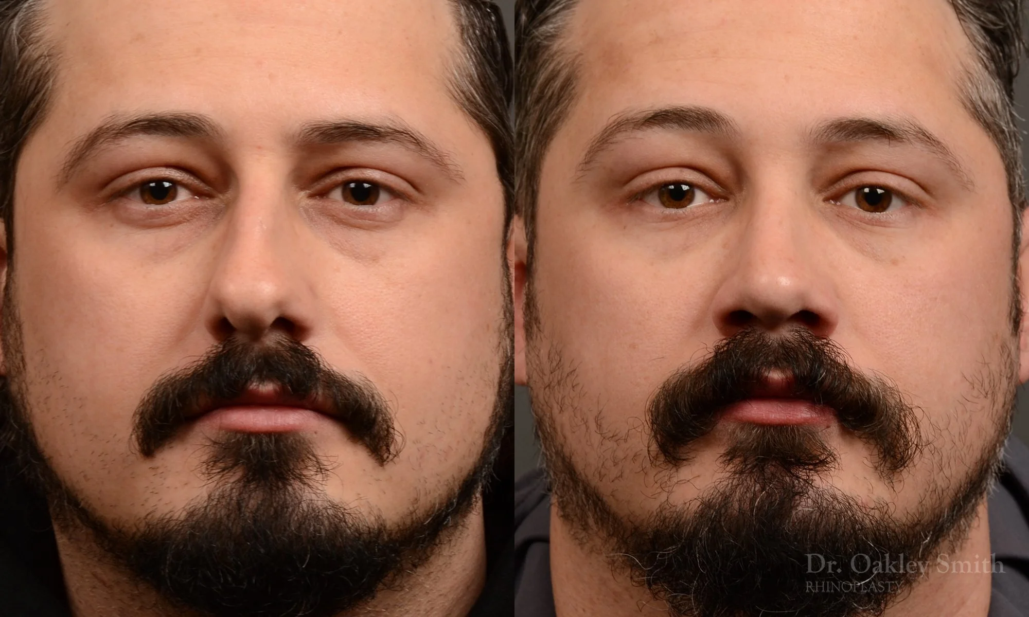 501A-male-rhinoplasty-dr-oakley-smith-toronto-top-surgeon-nose-job.jpg