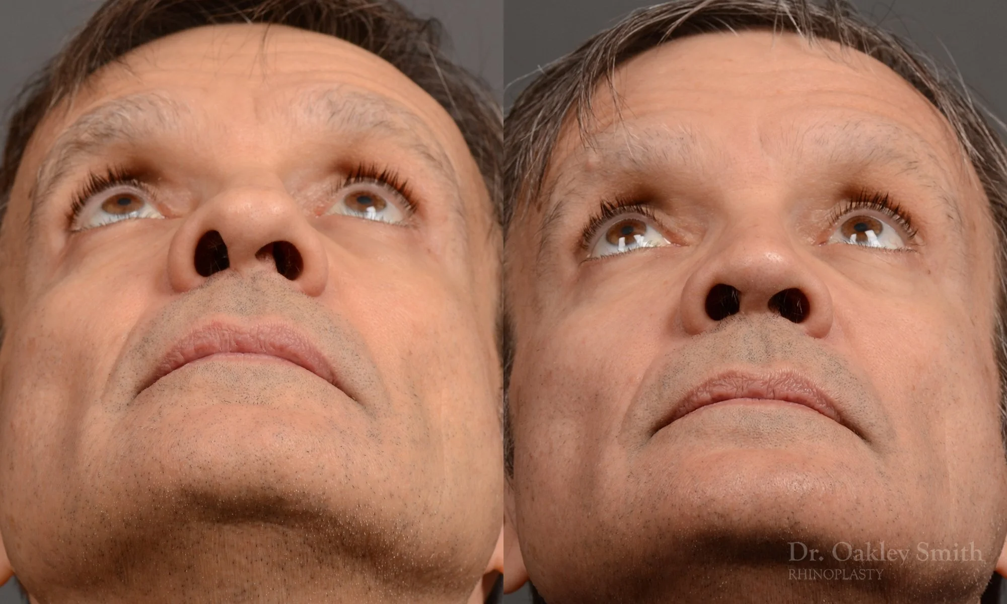 306.1F-rhinoplasty-dr-oakley-smith-toronto-nose-job.jpg