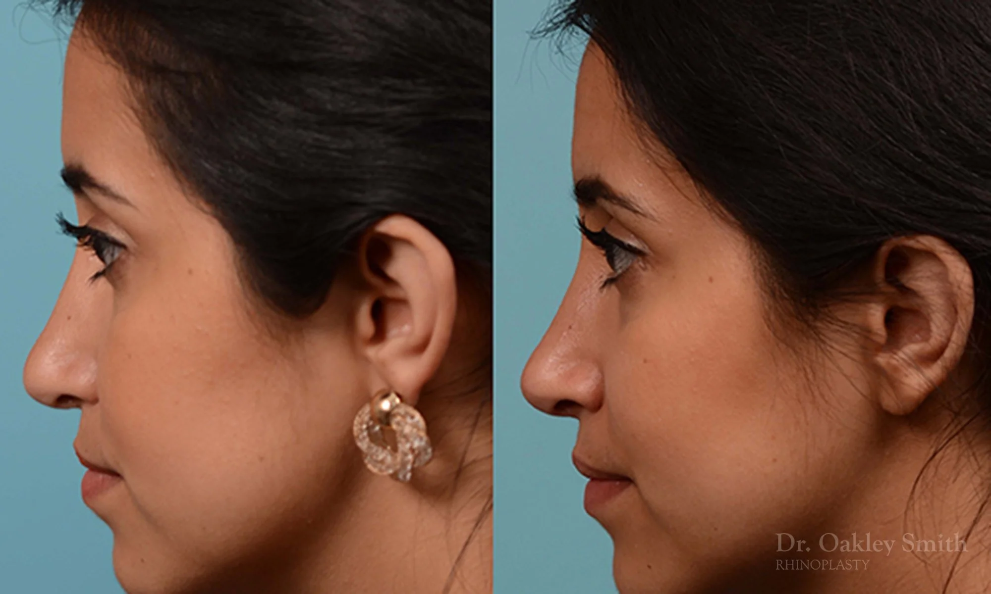 226E-rhinoplasty-dr-oakley-smith-toronto-nose-job-1.jpg