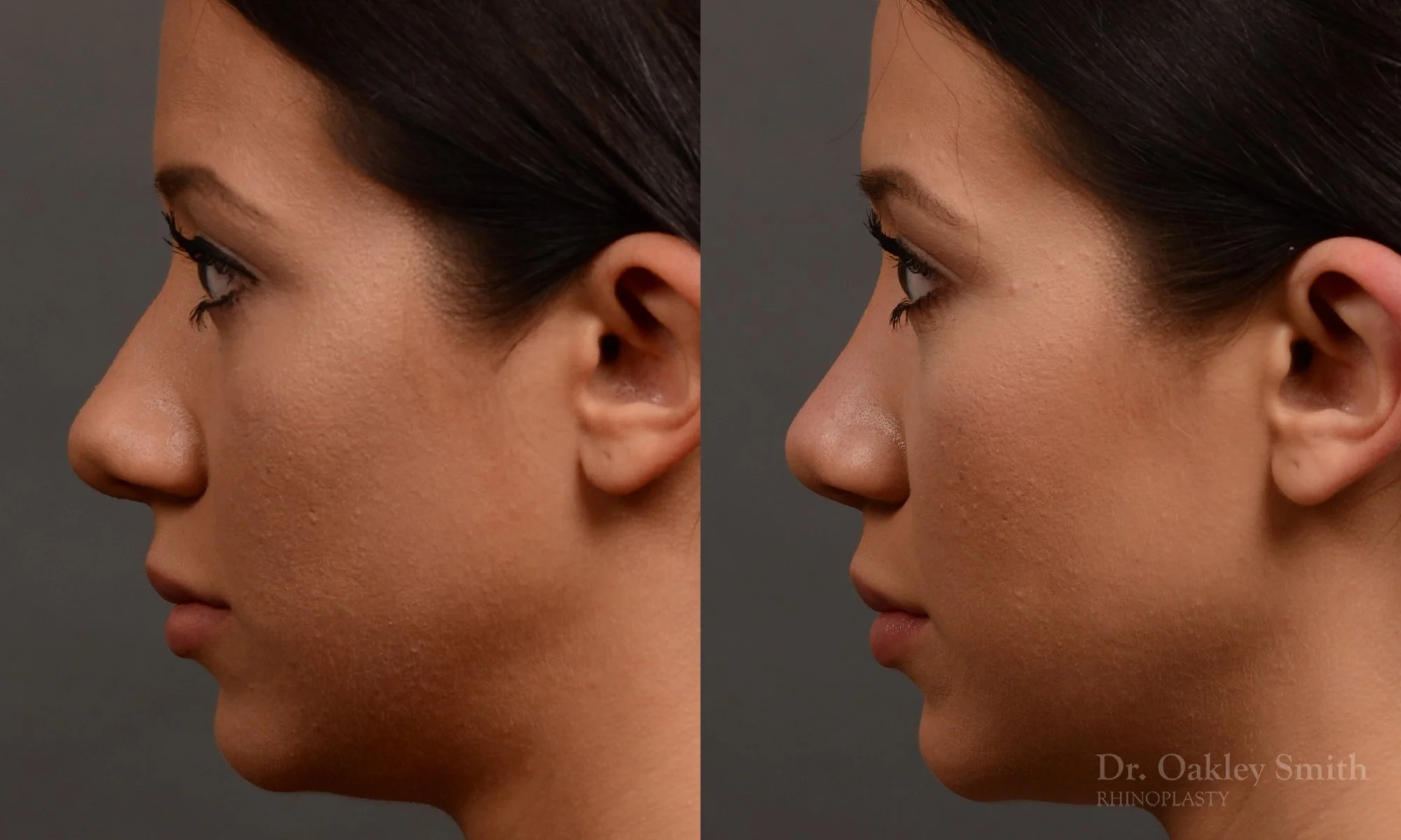 328E-rhinoplasty-dr-oakley-smith-toronto-nose-job.jpg