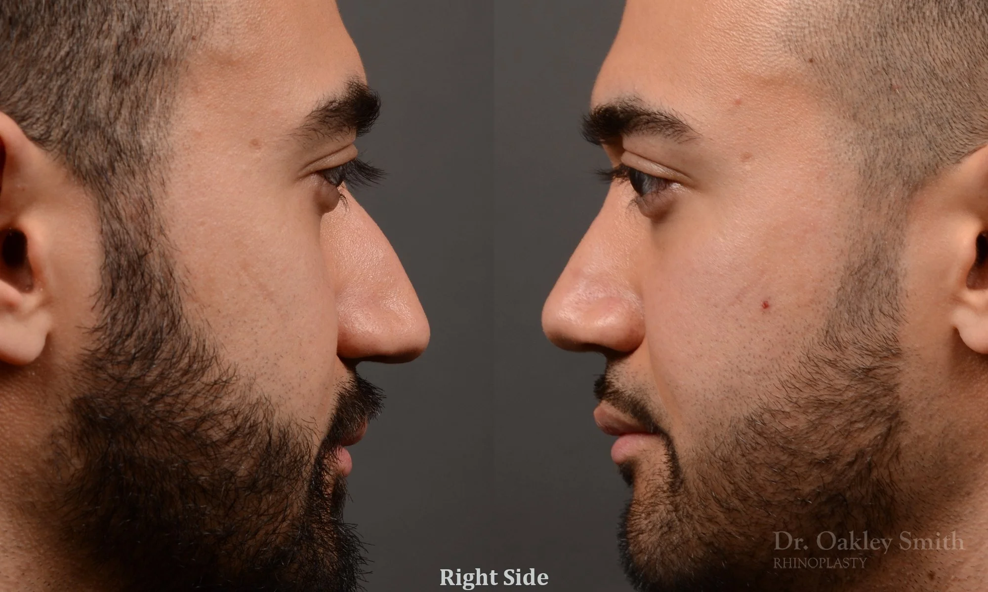 362: Primary Male Rhinoplasty, Normal Skin, Bridge Work, Tip Work