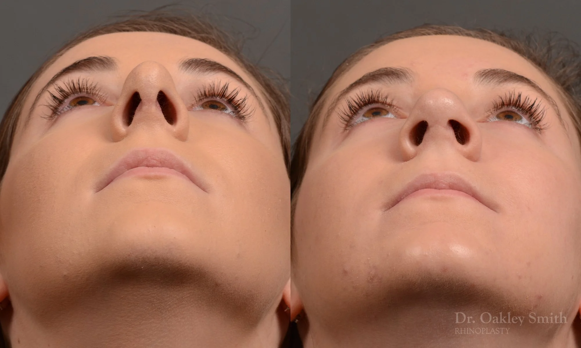 366F-rhinoplasty-dr-oakley-smith-toronto-nose-job.jpg