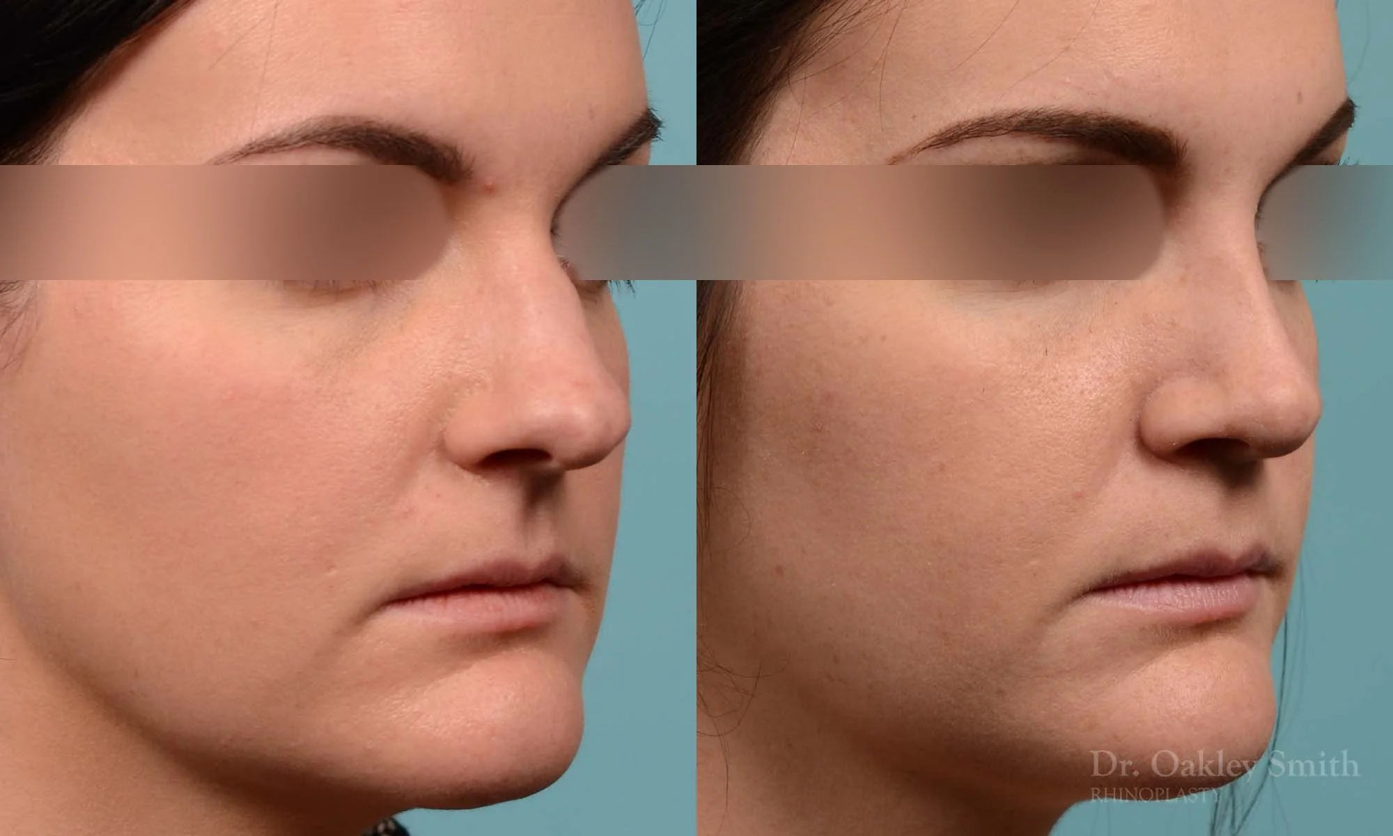 252B-rhinoplasty-dr-oakley-smith-toronto-nose-job.jpg