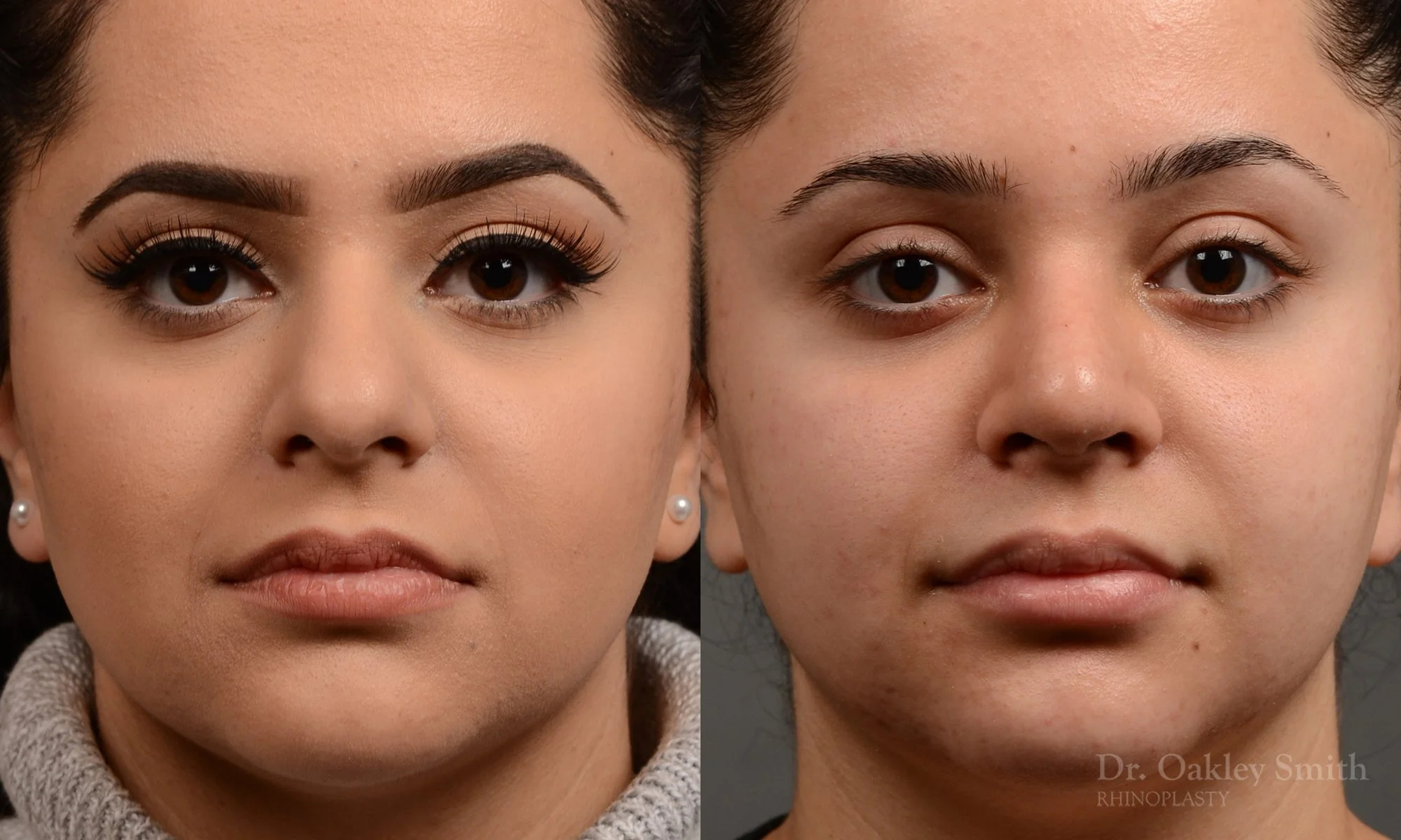 304A-rhinoplasty-dr-oakley-smith-toronto-nose-job.jpg