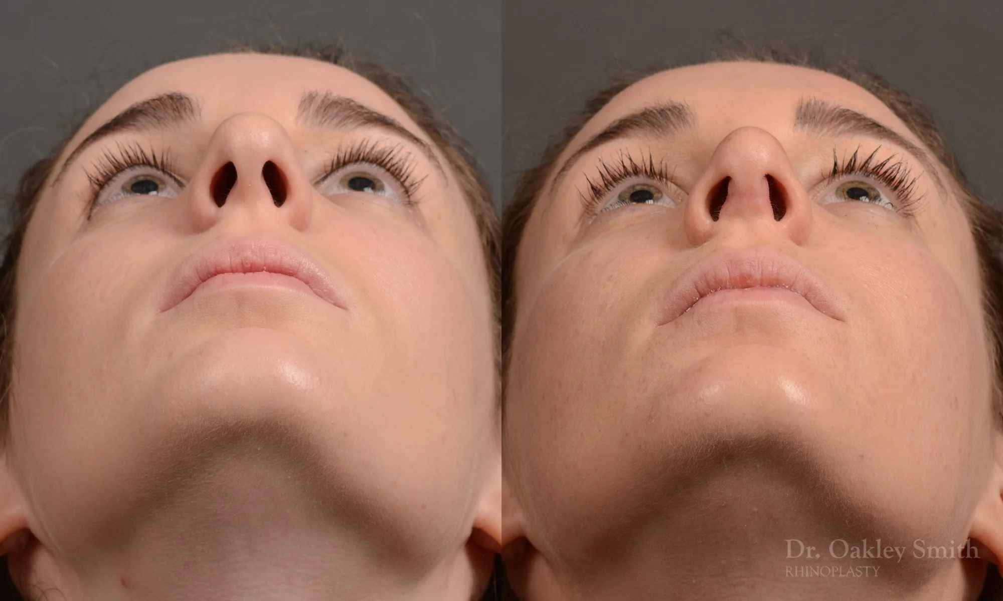 358F-rhinoplasty-dr-oakley-smith-toronto-nose-job.jpg