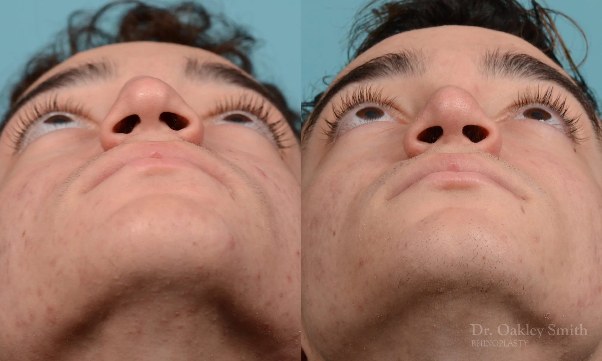 212F-rhinoplasty-dr-oakley-smith-toronto-nose-job.jpg