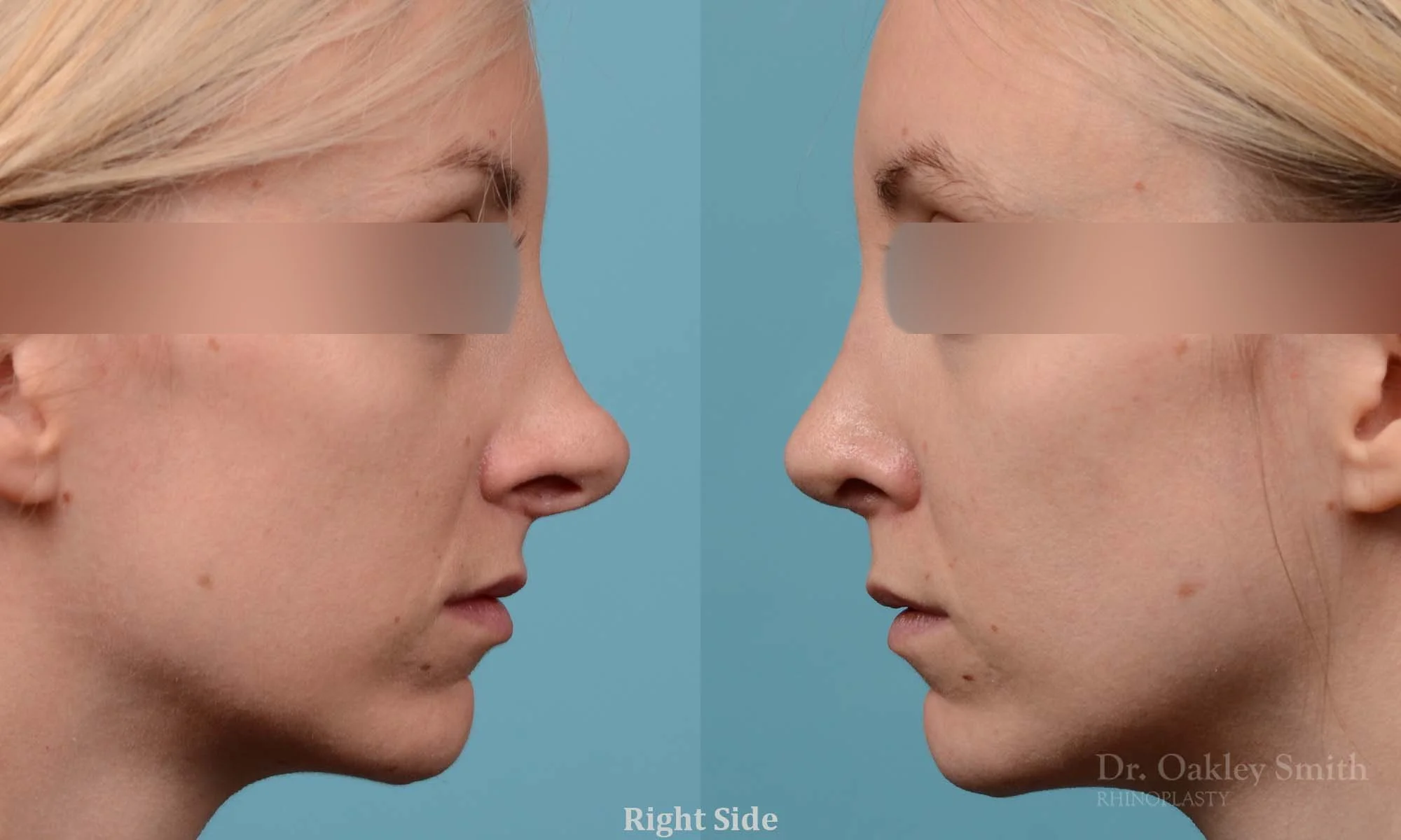 280: Female, Revision Rhinoplasty, Tip Reconstruction