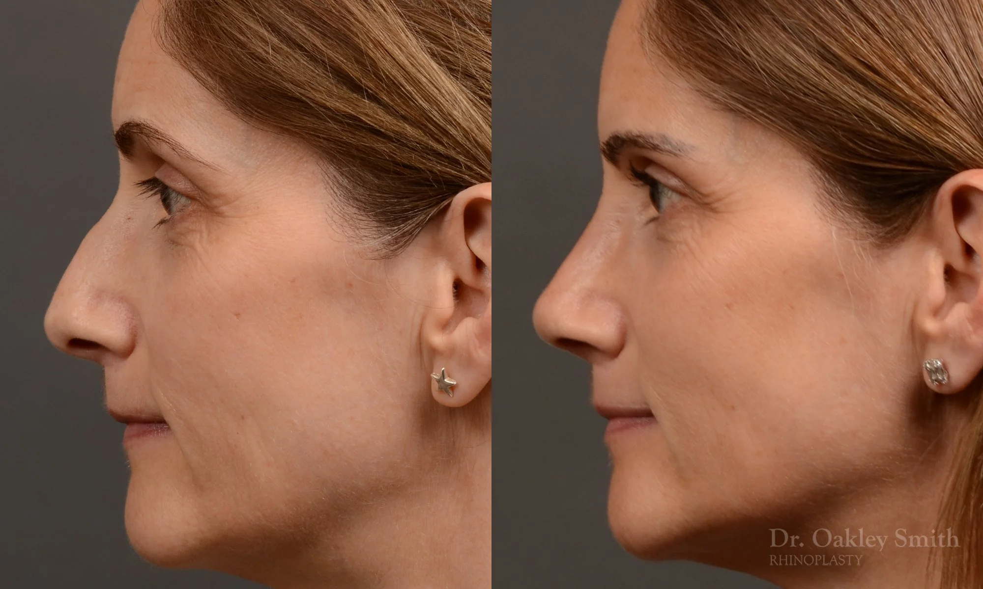 546E-rhinoplasty-nose-job-top-toronto-surgeon-dr-oakley-smith.jpg