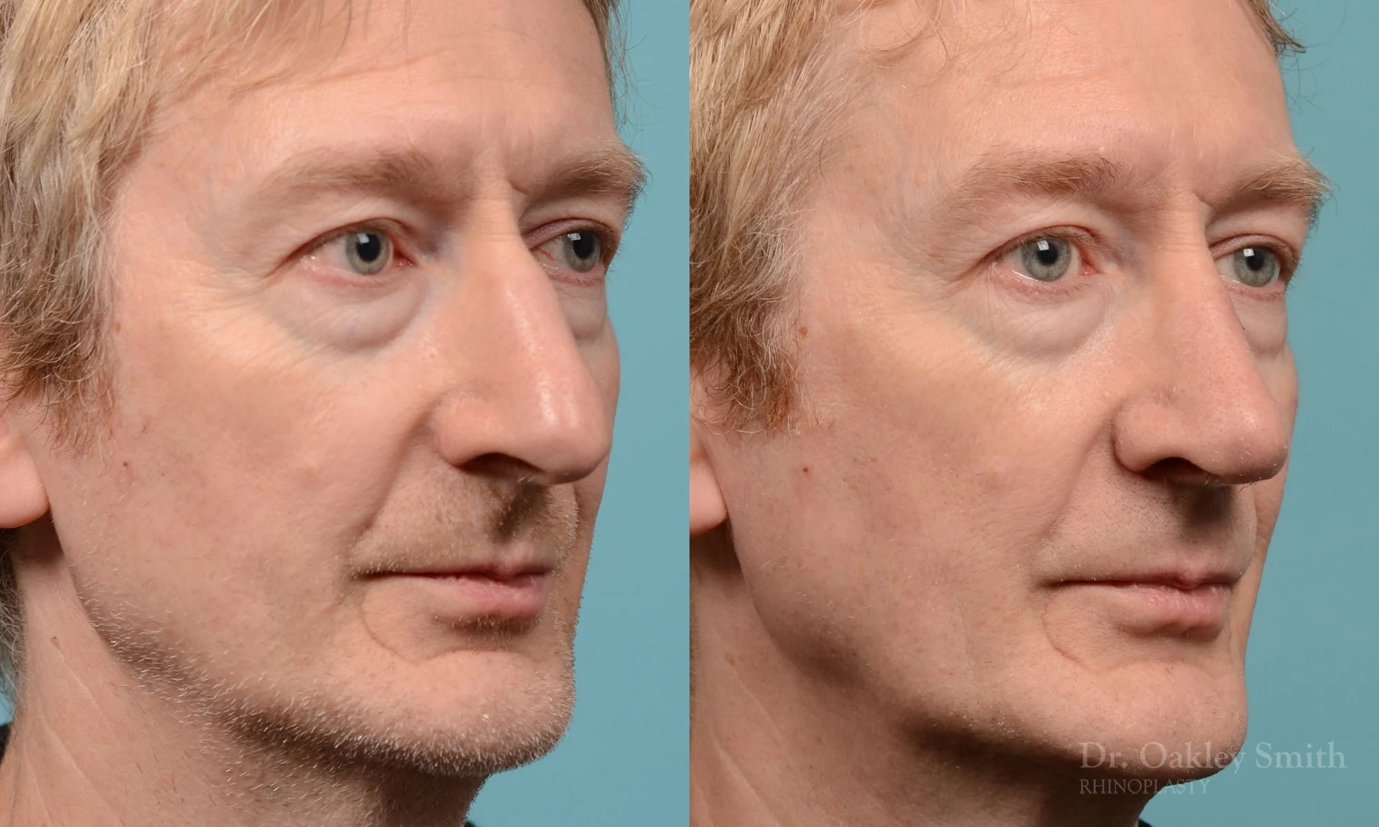 276B-rhinoplasty-dr-oakley-smith-toronot-nose-job.jpg