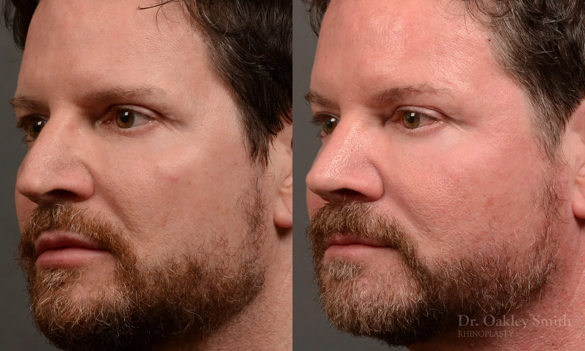 Case 560, Dr. Oakley Smith, male rhinoplasty, 12 months after surgery, left oblique view