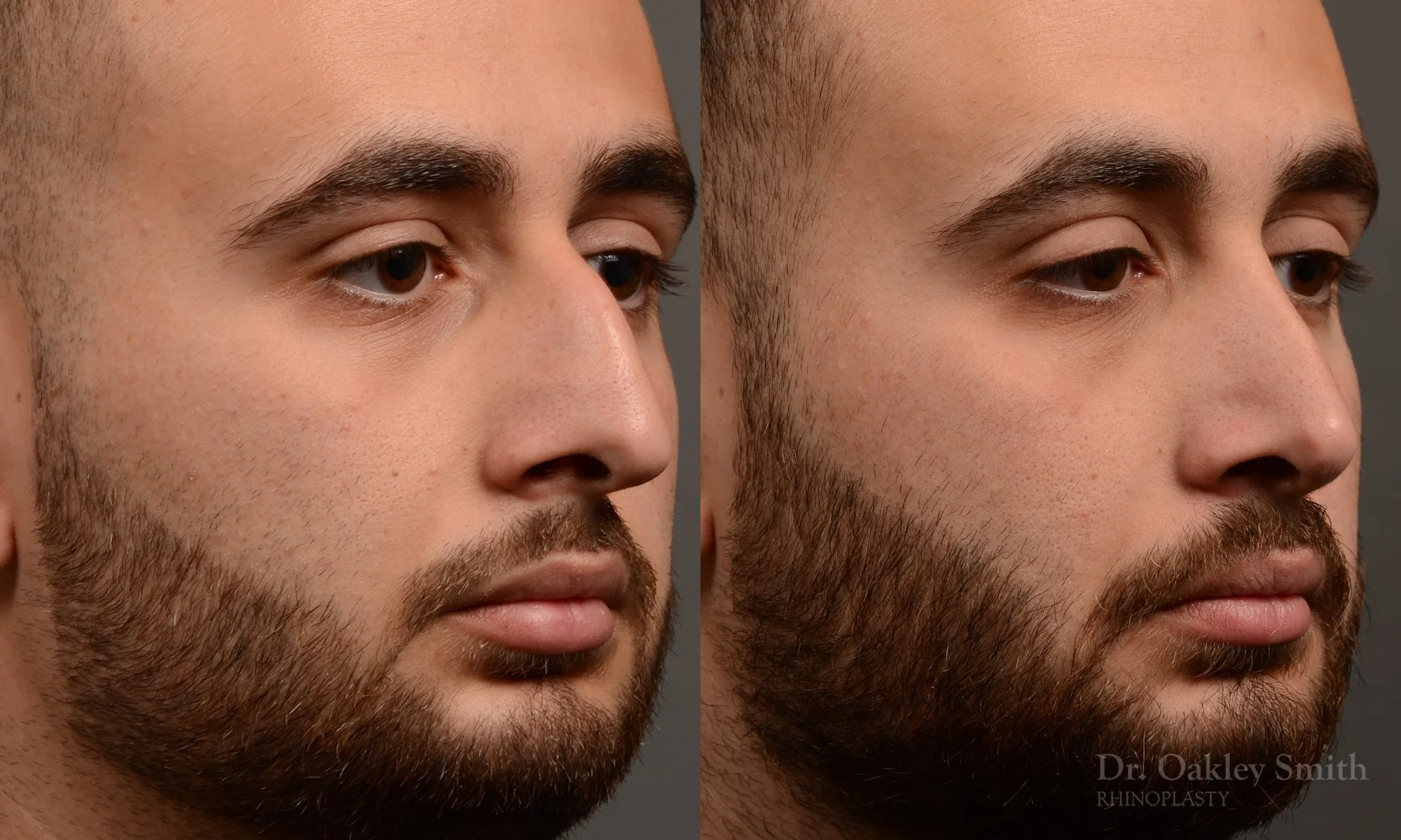391B-rhinoplasty-dr-oakley-smith-toronto-nose-job.jpg