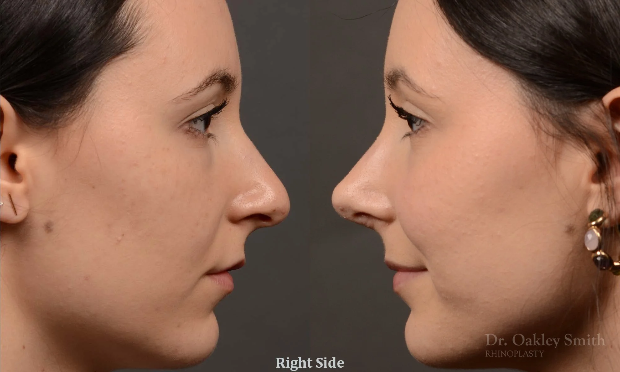 449.1C-revision-rhinoplasty-dr-oakley-smith-toronto-top-surgeon-nose-job.jpg