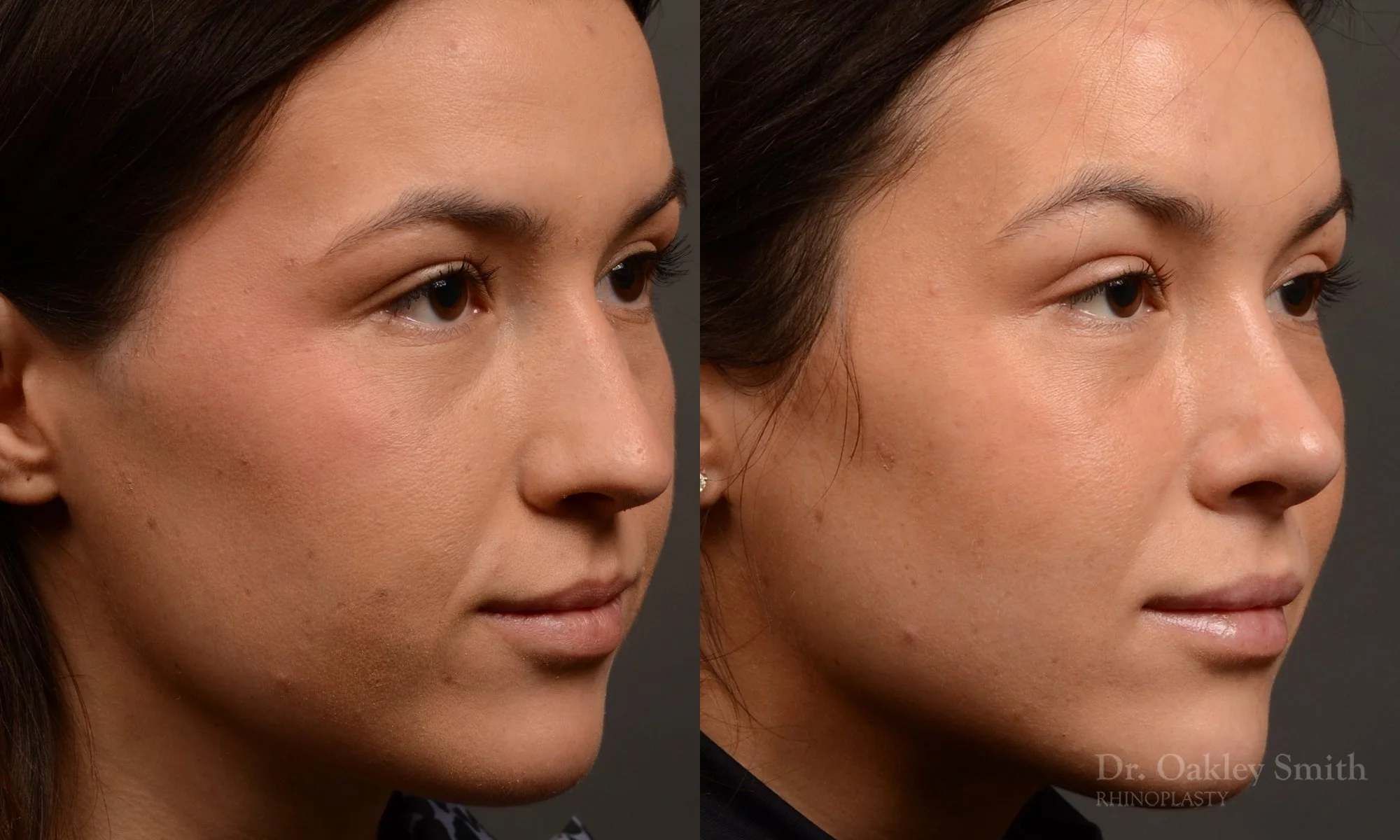549B-rhinoplasty-nose-job-toronto-nose-surgeon-dr-oakley-smith.jpg