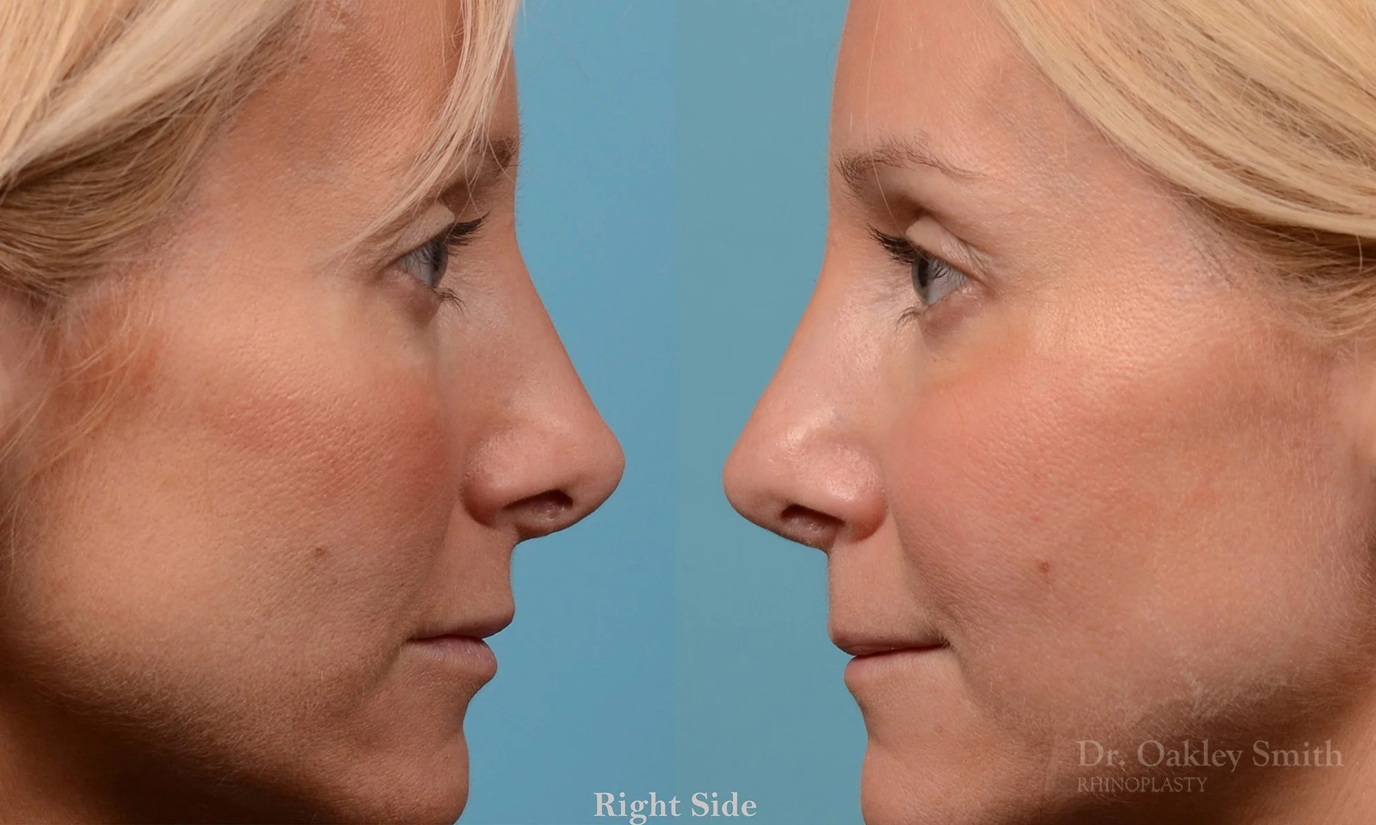 232: Female, Revision Rhinoplasty, Tip Reconstruction with grafts