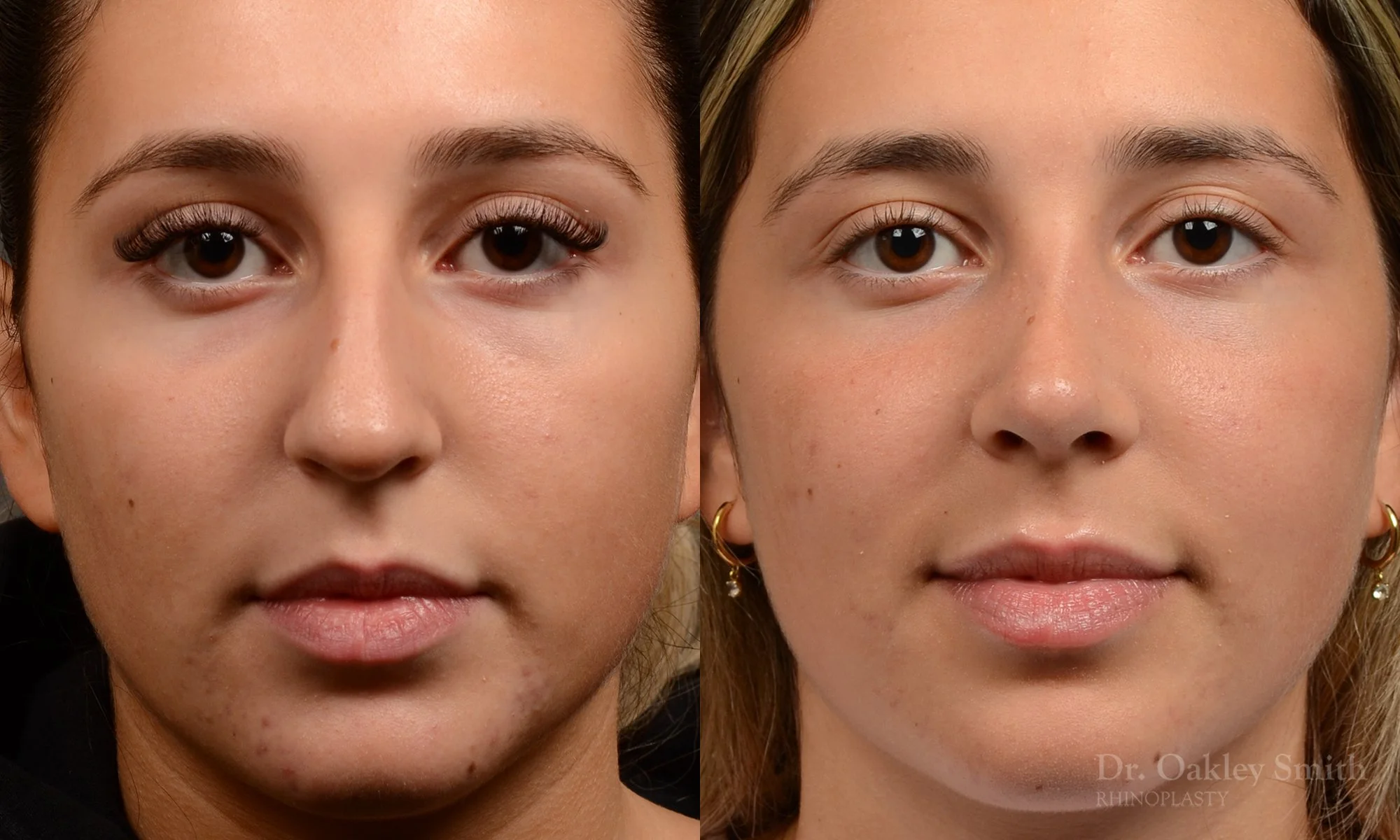 Case 563, Dr. Oakley Smith, preservation rhinoplasty, 12 months after surgery, frontal view