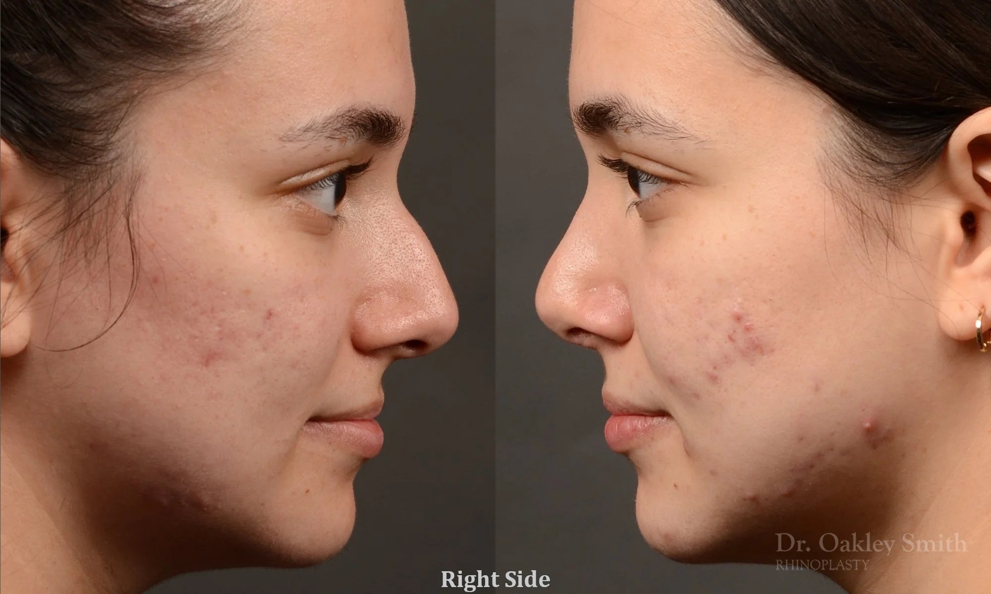 554: Female Rhinoplasty, Dorsal Hump, Crooked