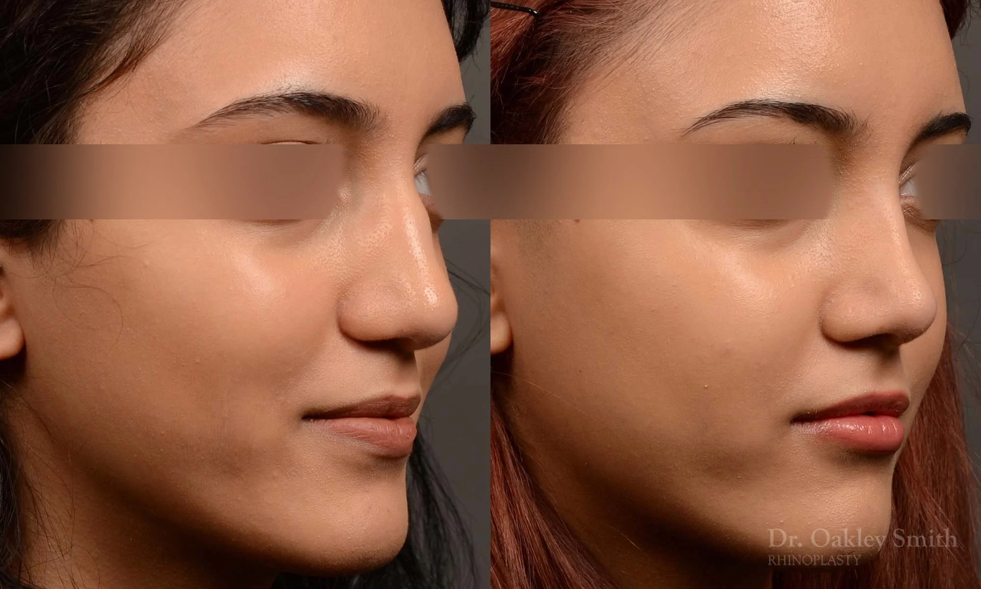 533B-rhinoplasty-dr-oakley-smith-toronto-top-surgeon-nose-job.jpg