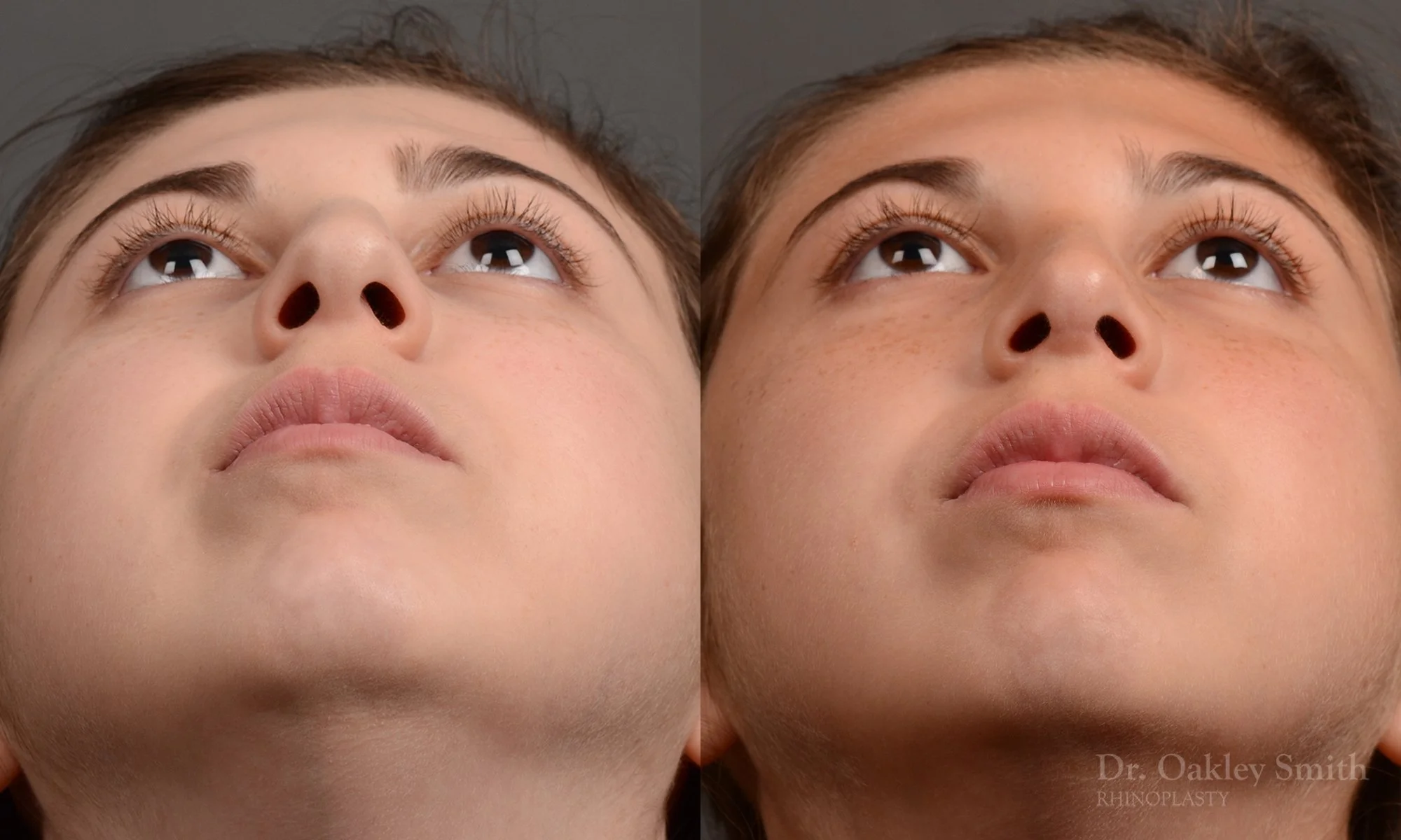 371F-rhinoplasty-dr-oakley-smith-toronto-nose-job.jpg