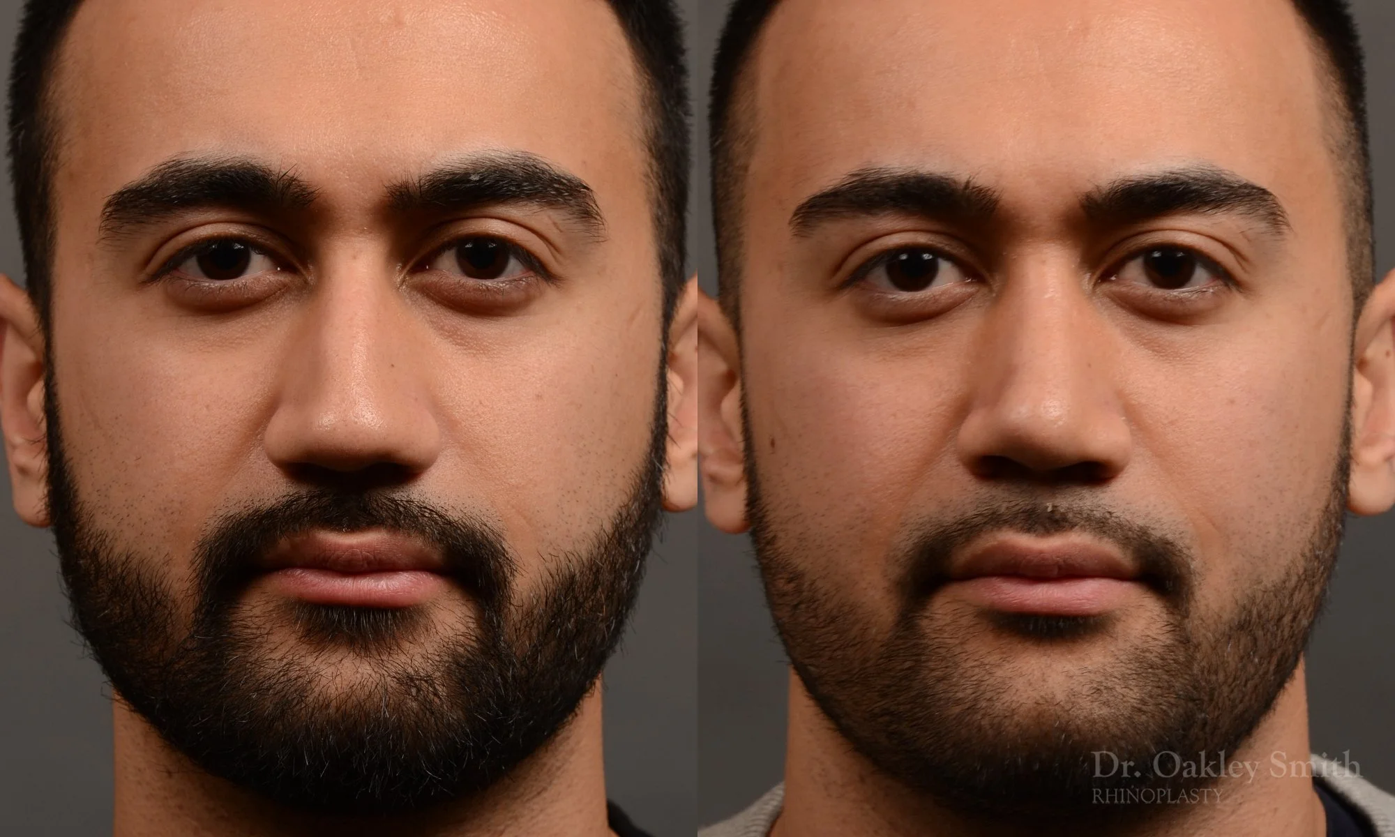 362.1A-rhinoplasty-dr-oakley-smith-toronto-nose-job.jpg
