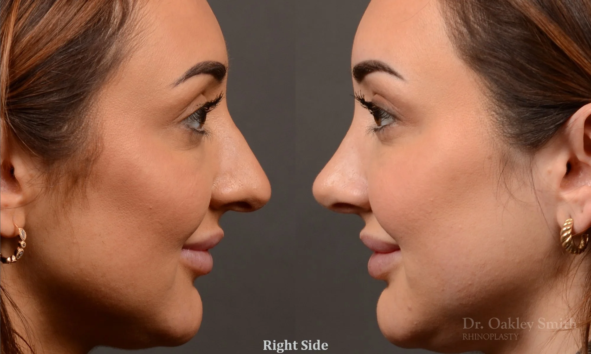 502: Female, Primary  Rhinoplasty, Normal Skin, Bridge Work, Tip Work, Crooked