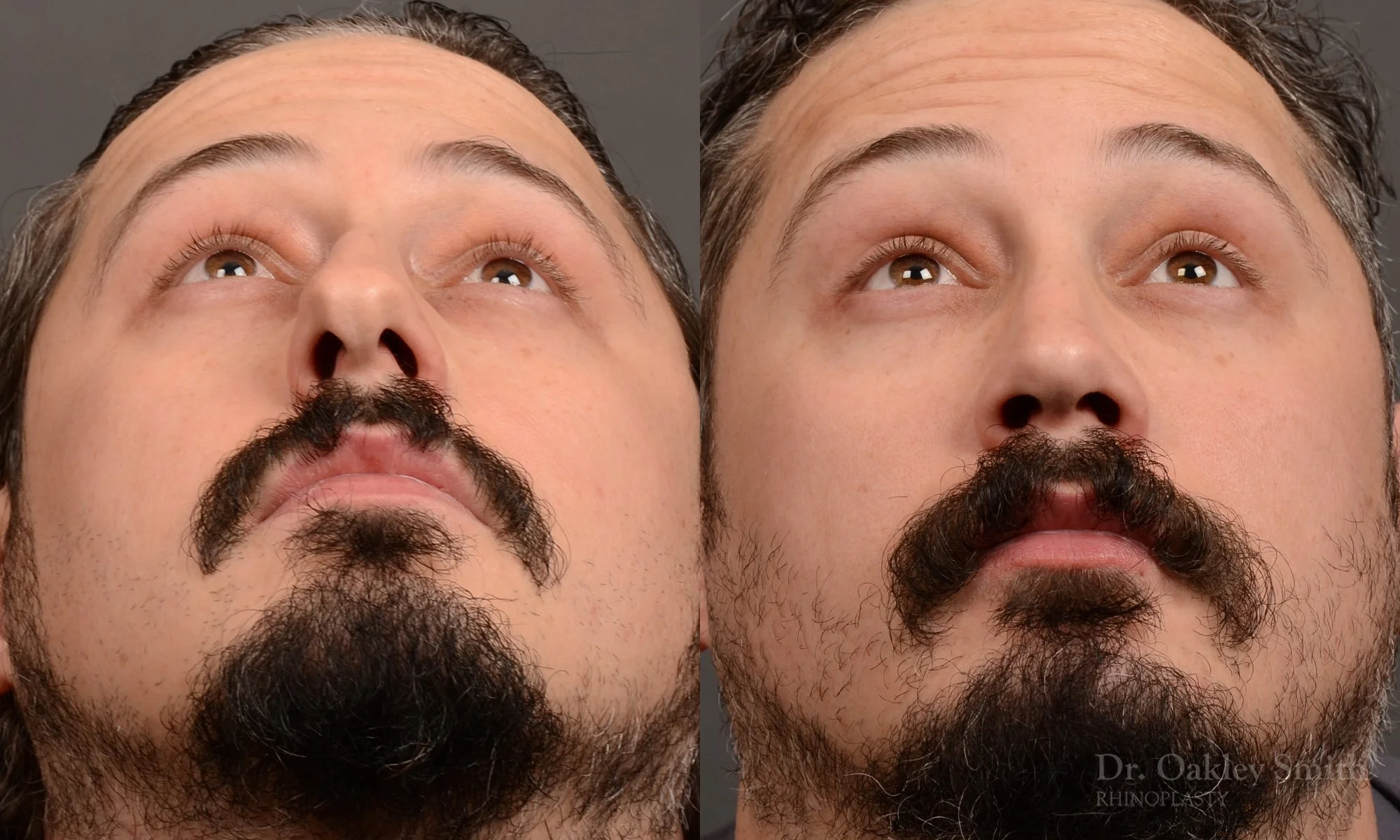 501F-male-rhinoplasty-dr-oakley-smith-toronto-top-surgeon-nose-job.jpg