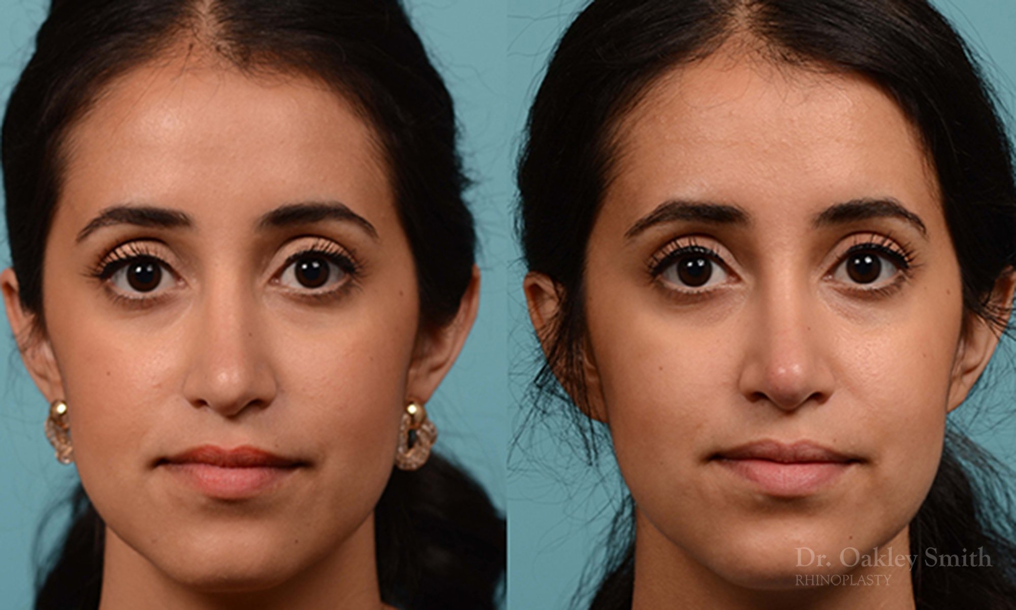 226A-rhinoplasty-dr-oakley-smith-toronto-nose-job-1.jpg