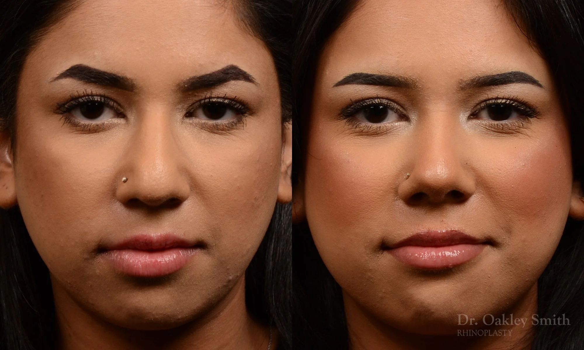 Case 557 Dr. Oakley Smith, preservation rhinoplasty, 12 months after surgery, frontal view