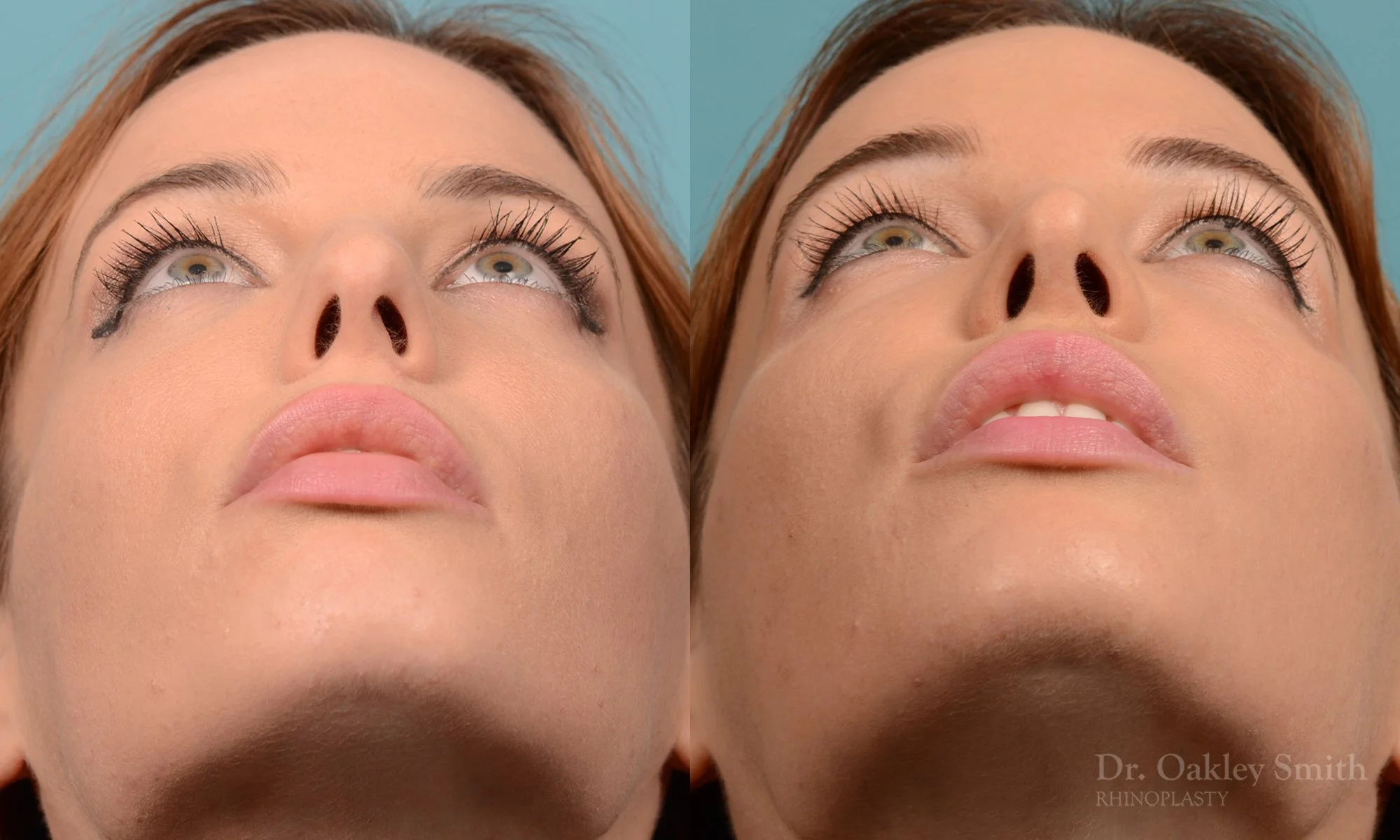 231F-rhinoplasty-dr-oakley-smith-toronto-nose-job-long-nose-bump-bridge-2.jpg