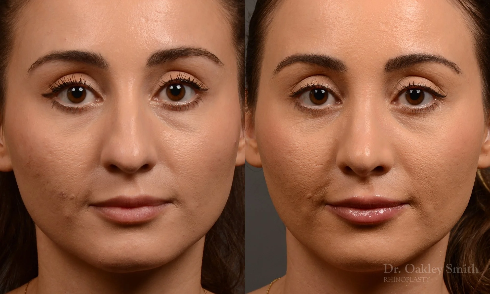 522A-rhinoplasty-dr-oakley-smith-toronto-top-surgeon-nose-job.jpg