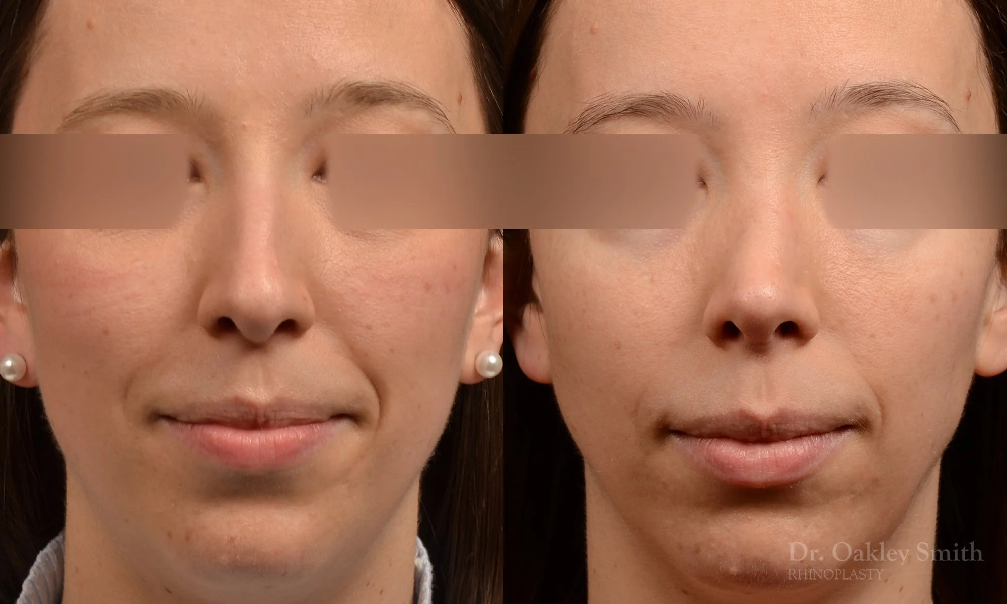 534A-hinoplasty-dr-oakley-smith-toronto-top-surgeon-nose-job.jpg