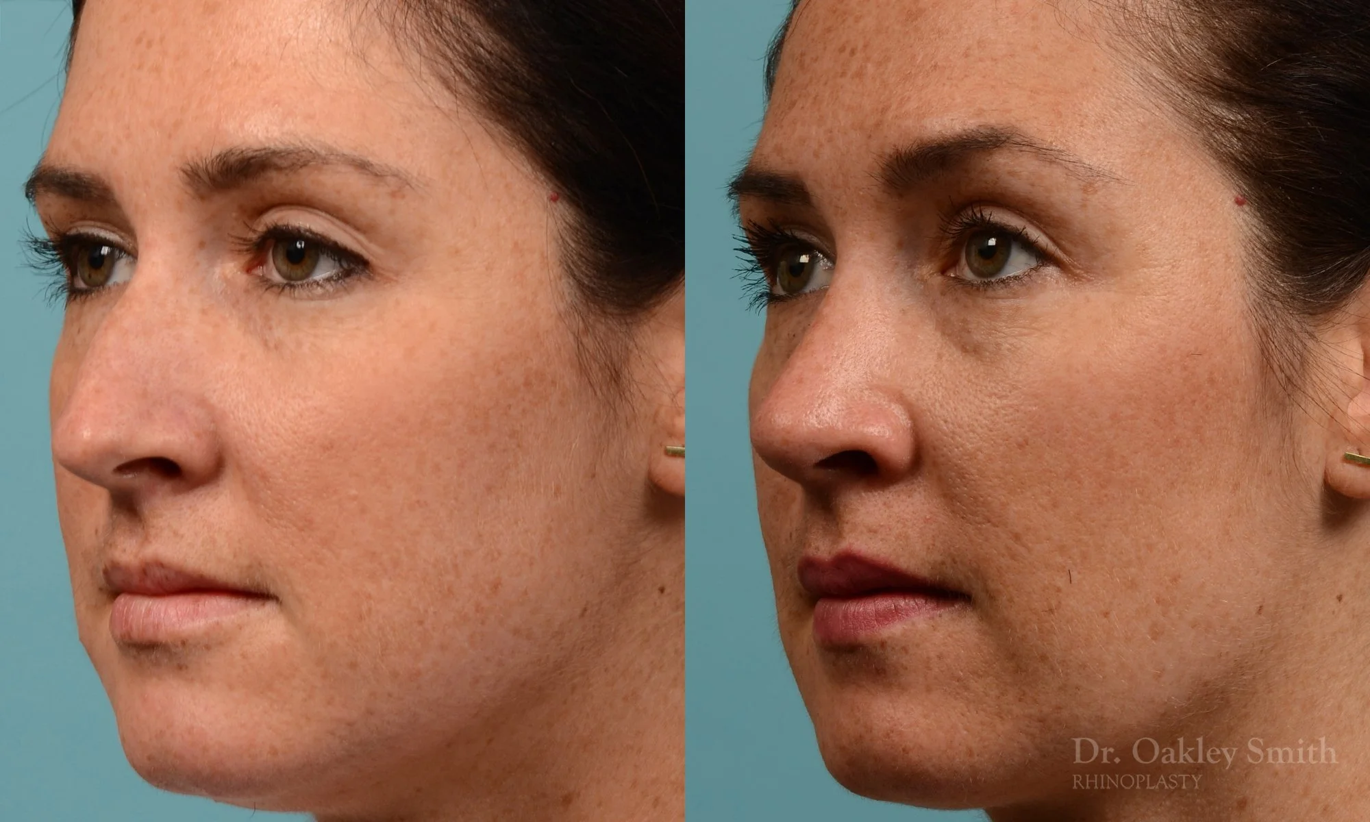302D-rhinoplasty-dr-oakley-smith-toronto-nose-job.jpg