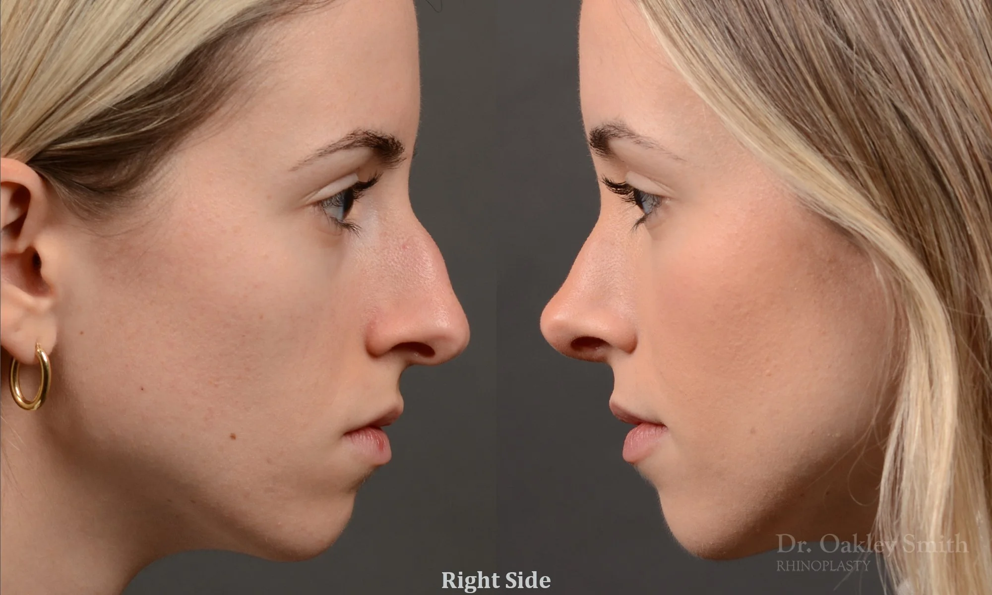 531C-rhinoplasty-dr-oakley-smith-toronto-top-surgeon-nose-job.jpg