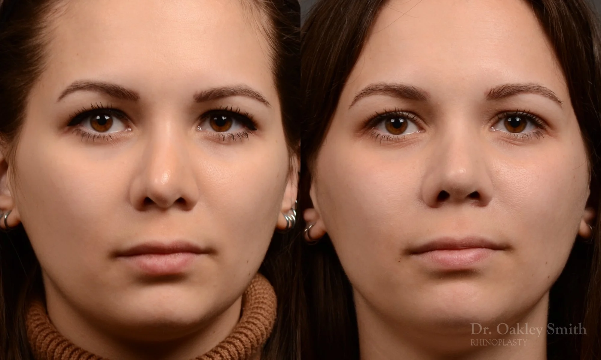 542A-rhinoplasty-before-and-after-nose-job-toronto-Dr.-Oakley-Smith.jpg