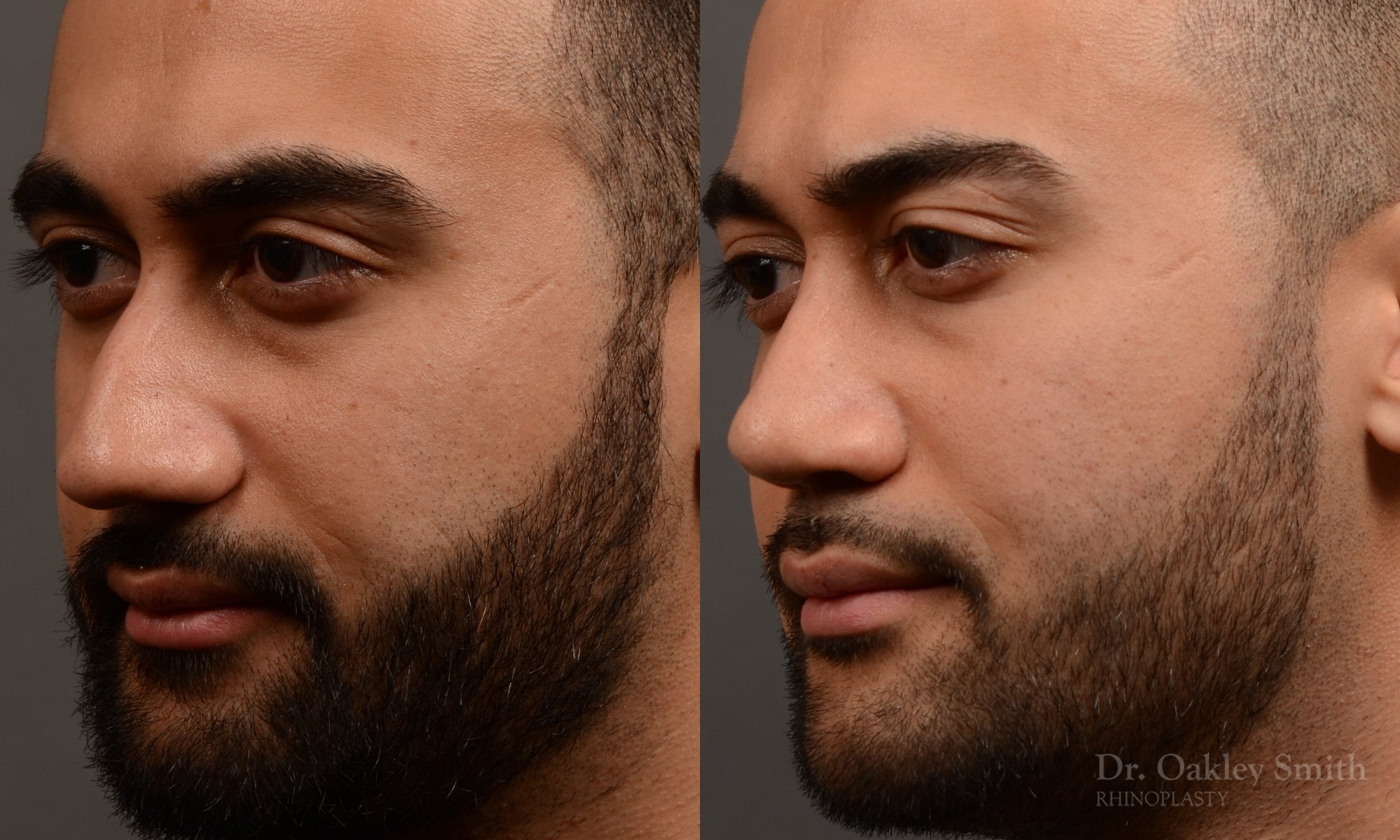 362.1D-rhinoplasty-dr-oakley-smith-toronto-nose-job.jpg