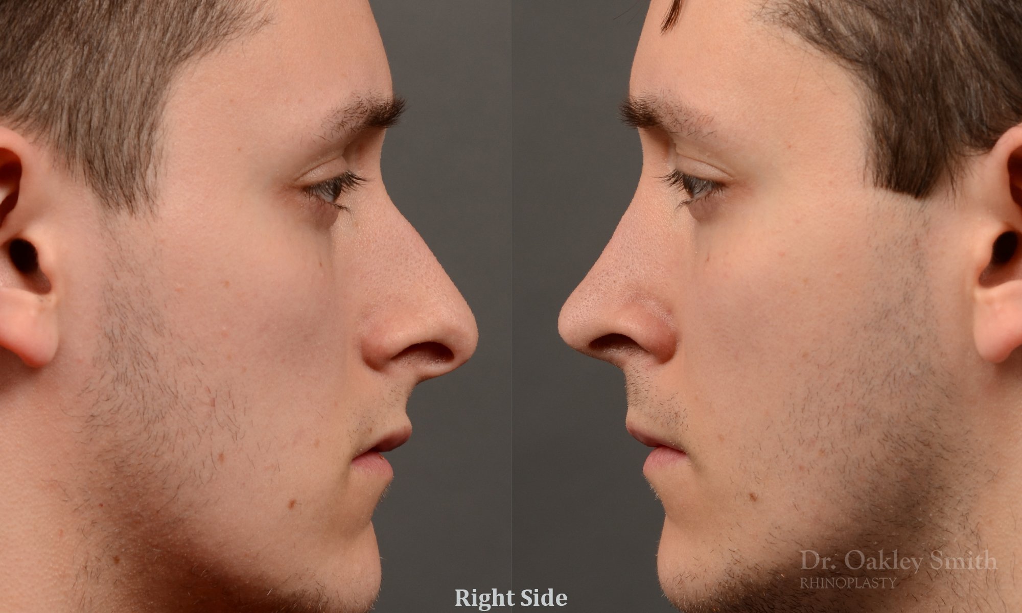 477: Primary Male Rhinoplasty, Normal Skin, Bridge Work, Tip Work