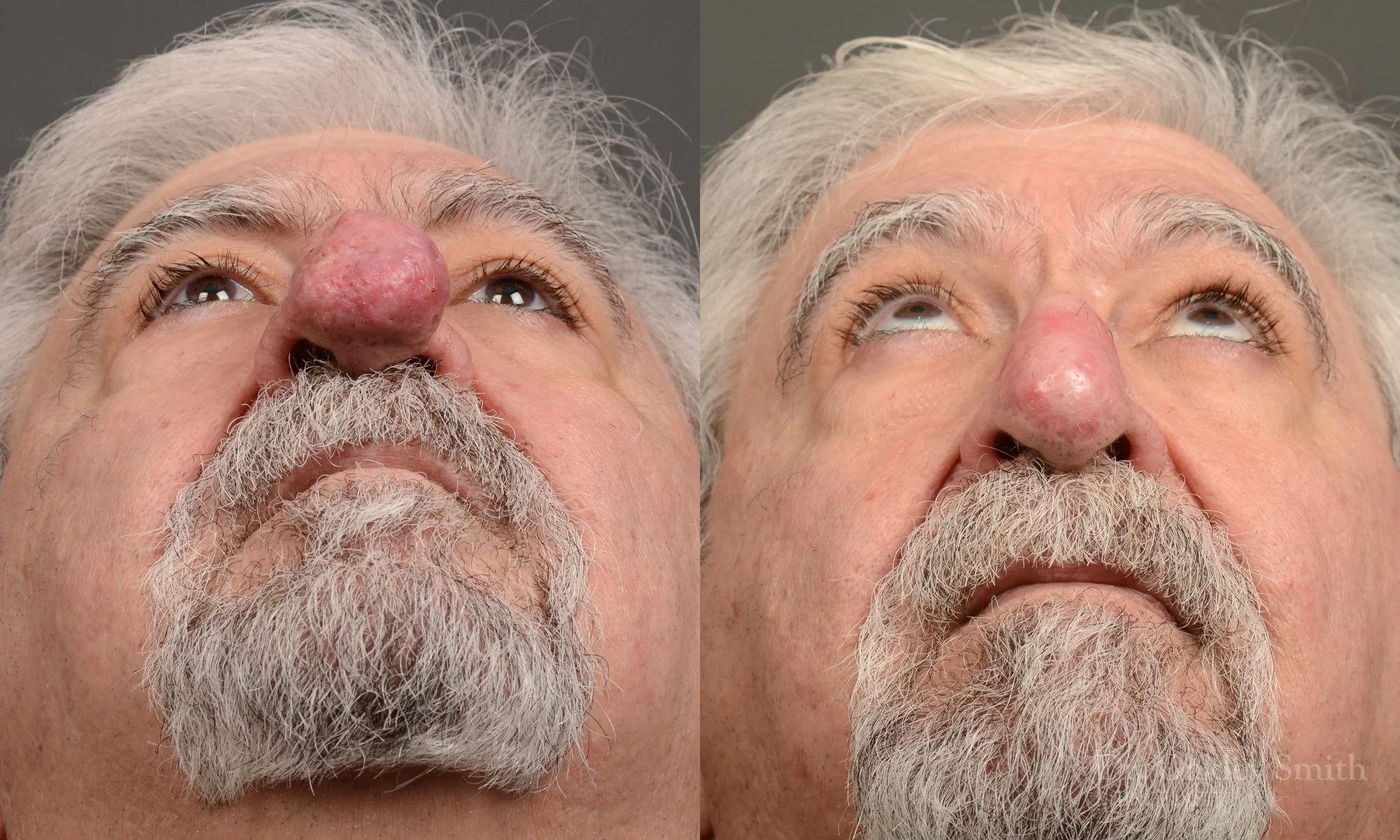 Case 562, Dr. Oakley Smith, rhinophyma rhinoplasty, 12 months after surgery, submental view